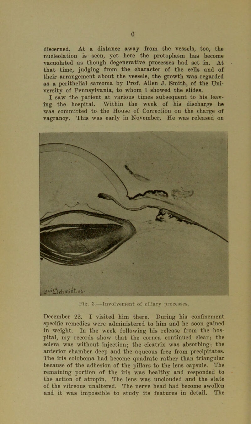 discerned. At a distance away from the vessels, too, the nucleolation is seen, yet here the protoplasm has become vacuolated as though degenerative processes had set in. At that time, judging from the character of the cells and of their arrangement about the vessels, the growth was regarded as a perithelial sarcoma by Prof. Allen J. Smith, of the Uni- versity of Pennsylvania, to whom I showed the slides. I saw the patient at various times subsequent to his leav- ing the hospital. Within the week of his discharge he was committed to the House of Correction on the charge of vagrancy. This was early in November. He was released on December 22. I visited him there. During his confinement specific remedies were administered to him and he soon gained in weight. In the week following his release from the hos- pital, my records show that the cornea continued clear; the sclera was without injection; the cicatrix was absorbing; the anterior chamber deep and the aqueous free from precipitates. The iris coloboma had become quadrate rather than triangular because of the adhesion of the pillars to the lens capsule. The remaining portion of the iris was healthy and responded to the action of atropin. The lens was unclouded and the state of the vitreous unaltered. The nerve head had become swollen and it was impossible to study its features in detail. The Fig. 3.—Involvement of ciliary processes.