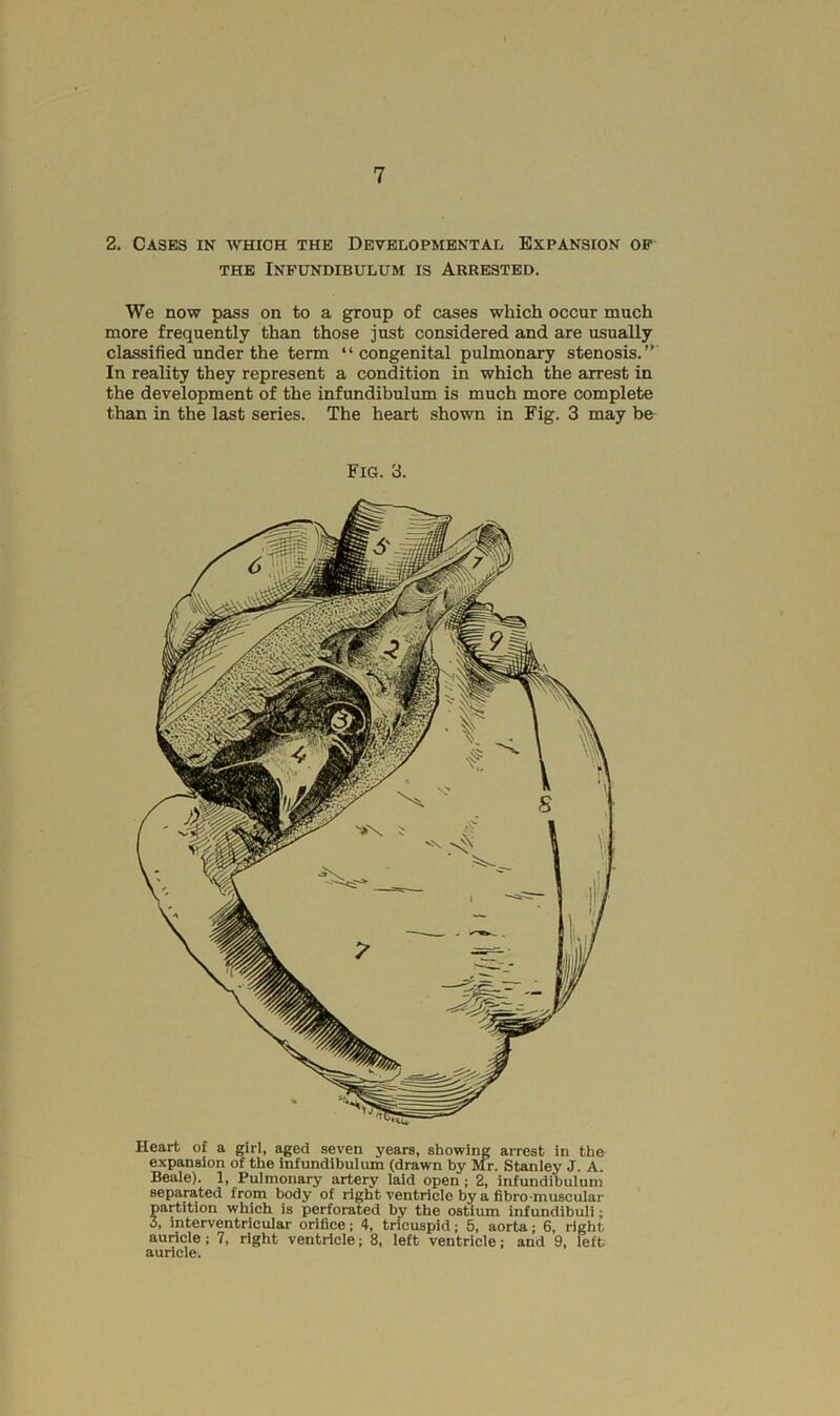 2. Cases in which the Developmental Expansion op THE Infundibulum is Arrested. We now pass on to a group of cases which occur much more frequently than those just considered and are usually classified under the term “ congenital pulmonary stenosis.”' In reality they represent a condition in which the arrest in the development of the infundibulum is much more complete than in the last series. The heart shown in Fig. 3 may be Fig. 3. Heart of a girl, aged seven years, showing arrest in the expansion of the infundibulum (drawn by Mr. Staniey J. A. Beaie). 1, Pulmonary artery laid open; 2, infundibulum separated from body of right ventricle by a fibro-muscular partition which is perforated by the ostium infundibuli; 3, Interventricular orifice; 4, tricuspid; 5, aorta; 6, right auricle; 7, right ventricle; 8, left ventricle; and 9, left auricle.