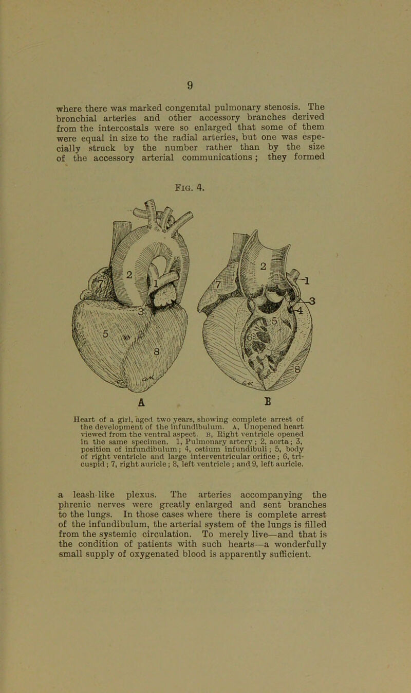 where there was marked congenital pulmonary stenosis. The bronchial arteries and other accessory branches derived from the intercostals were so enlarged that some of them were equal in size to the radial arteries, but one was espe- cially struck by the number rather than by the size of the accessory arterial communications; they formed Fig. 4. Heart of a girl, aged two years, showing complete arrest of the development of the infundibulum, a. Unopened heart viewed from the ventral aspect, b. Right ventricle opened in the same specimen. 1, Pulmonary artery; 2, aorta; 3, position of infundibulum; 4, ostium infundibuli; 5, body of right ventricle and large interventricular orifice; 6, tri- cuspid ; 7, right auricle; 8, left ventricle ; and 9, left auricle. a leash like plexus. The arteries accompanying the phrenic nerves were greatly enlarged and sent branches to the lungs. In those cases where there is complete arrest of the infundibulum, the arterial system of the lungs is filled from the systemic circulation. To merely live—and that is the condition of patients with such hearts—a wonderfully small supply of oxygenated blood is apparently sufiBcient.