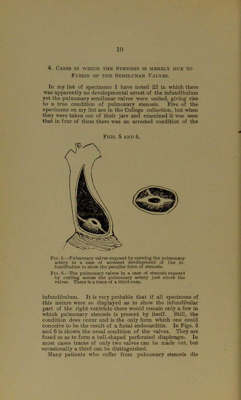 4. Cases in which the Stenosis is merely due to Fusion of the Semilunar Valves. In my list of specimens I have noted 23 in which there was apparently no developmental arrest of the infundibulum yet the pulmonary semilunar valves were united, giving rise to a true condition of pulmonary stenosis. Five of the specimens on my list are in the College collection, but when they were taken out of their jars and examined it was seen that in four of them there was an arrested condition of the Fig. 5.—Pulmonary valves exposed by opening the pulmonary artery in a case of arrested development of the in- fundibulum to show the peculiar form of stenosis. Fig. 6.—The pulmonary valves in a case of stenosis exposed by cutting across the pulmonary artery just above the valves. There is a trace of a third cusp. infundibulum. It is very probable that if all specimens of this nature were so displayed as to show the infundibular part of the right ventricle there would remain only a few in which pulmonary stenosis is present by itself. Still, the condition does occur and is the only form which one could conceive to be the result of a foetal endocarditis. In Figs. 5 and 6 is shown the usual condition of the valves. They are fused so as to form a bell-shaped perforated diaphragm. In most cases traces of only two valves can be made out, but occ.asionally a third can be distinguished. Many patients who suffer from pulmonary stenosis die