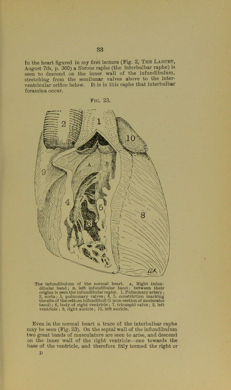 38 In the heart figured in my first lecture (Fig. 2, The Lancet, August 7th, p. 360) a fibrous raphe (the interbulbar raphe) is seen to descend on the inner wall of the infundibulum, stretching from the semilunar valves above to the inter- ventricular orifice below. It is in this raphe that interbulbar foramina occur. Fig. 23. The infundibulum of the normal heart, a, Eight infun- dibular band; B, left Infundibular band; between their origins is seen the infundibular raphe. 1, Pulmonary artery; 2, aorta; 3, pulmonary valves; 4, 5, constriction marking the site of the ostium infundibuli (5 is on section of moderator band); 6, body of right ventricle ; 7, tricuspid valve ; 8, left ventricle ; 9, right auricle; 10, left auricle. Even in the normal heart a trace of the interbulbar raphe may be seen (Fig. 23). On the septal wall of the infundibulum two great bands of musculature are seen to arise, and descend on the inner wall of the right ventricle—one towards the base of the ventricle, and therefore fitly termed the right or D