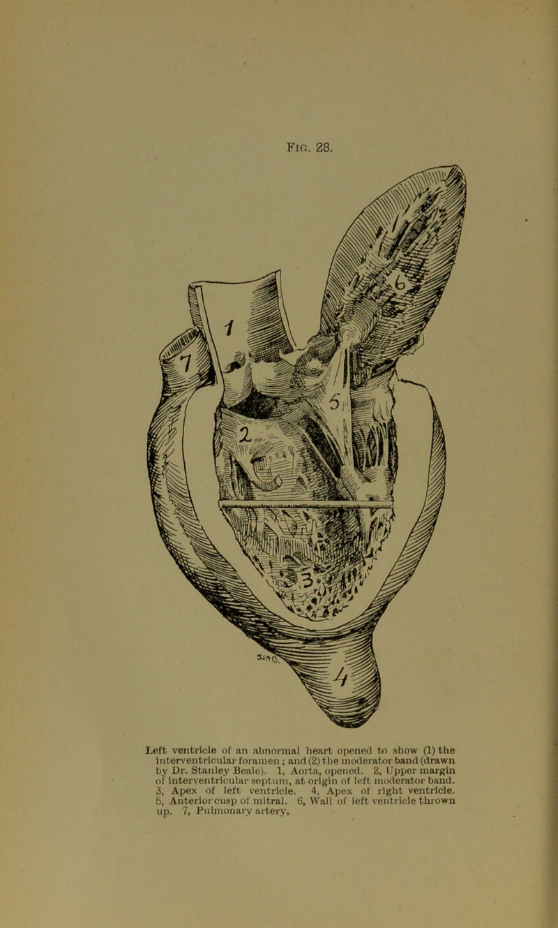 Left ventricle of an abnormal heart opened to show (1) the Inten'entricular foramen ; and (2) the modemtor band (drawn by Dr. Stanley Beale). 1, Aorta, opened. 2, Upper margin of interventricnlar septum, at origin of left moderator band. 3, Apex of left ventricle. 4, Apex of right ventricle. 5, Anterior cusp of mitral. 6, Wall of left ventricle thrown up. 7, Pulmonary artery.