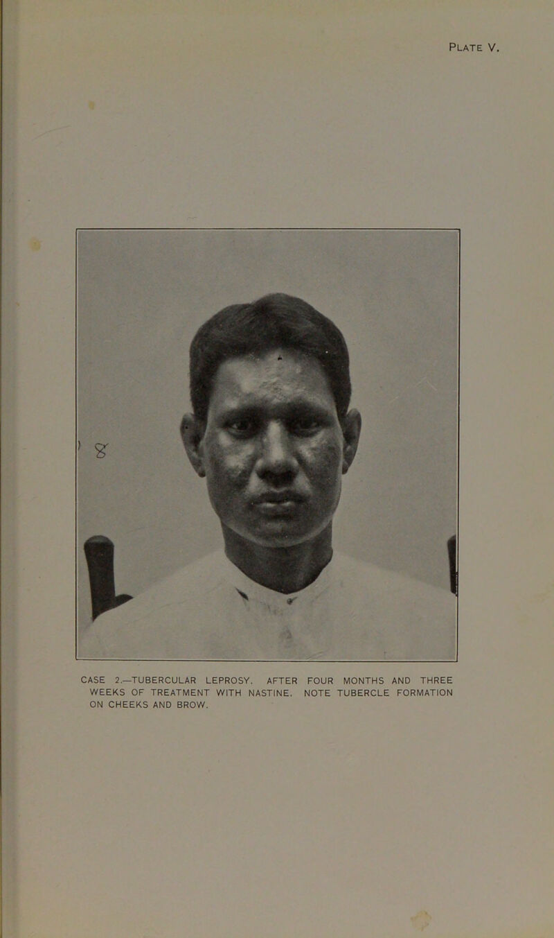 CASE 2.—TUBERCULAR LEPROSY. AFTER FOUR MONTHS AND THREE WEEKS OF TREATMENT WITH NASTINE. NOTE TUBERCLE FORMATION ON CHEEKS AND BROW.
