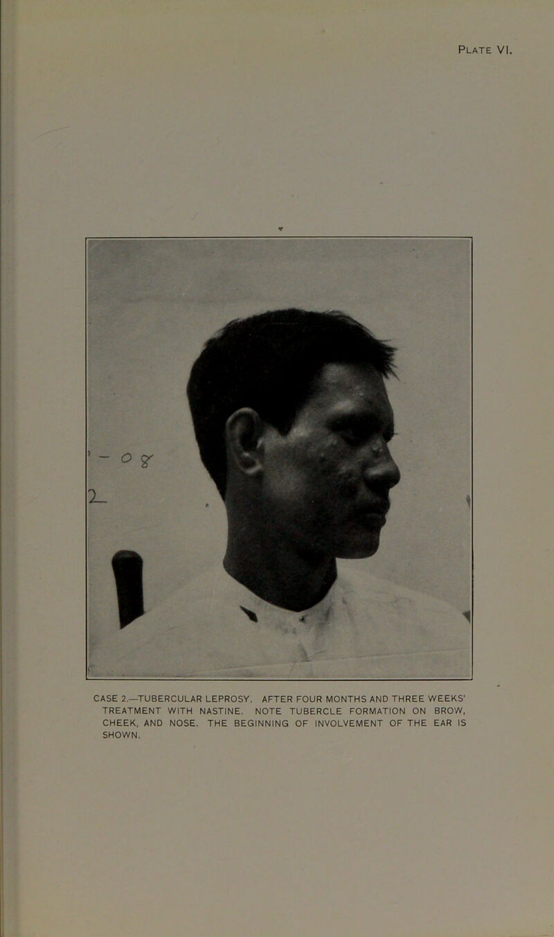 CASE 2.—TUBERCULAR LEPROSY. AFTER FOUR MONTHS AND THREE WEEKS' TREATMENT WITH NASTINE. NOTE TUBERCLE FORMATION ON BROW, CHEEK, AND NOSE. THE BEGINNING OF INVOLVEMENT OF THE EAR IS SHOWN.