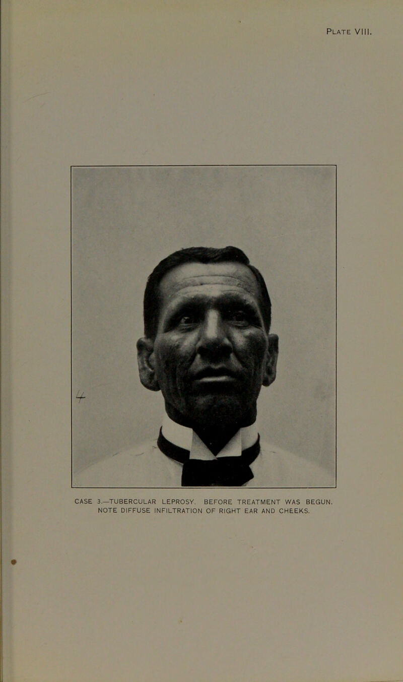 CASE 3.—TUBERCULAR LEPROSY. BEFORE TREATMENT WAS BEGUN. NOTE DIFFUSE INFILTRATION OF RIGHT EAR AND CHEEKS.