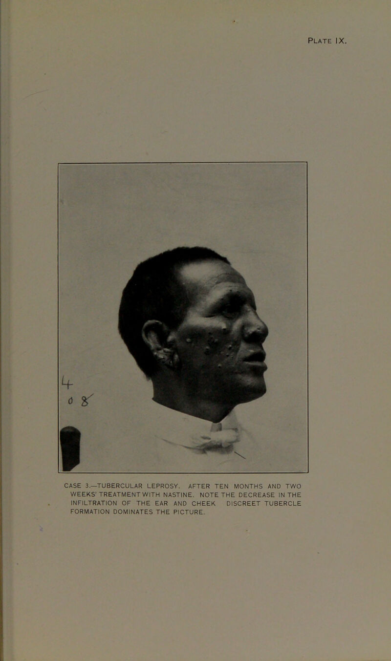 CASE 3.—TUBERCULAR LEPROSY. AFTER TEN MONTHS AND TWO WEEKS'TREATMENT WITH NAST1NE. NOTE THE DECREASE IN THE INFILTRATION OF THE EAR AND CHEEK DISCREET TUBERCLE FORMATION DOMINATES THE PICTURE.