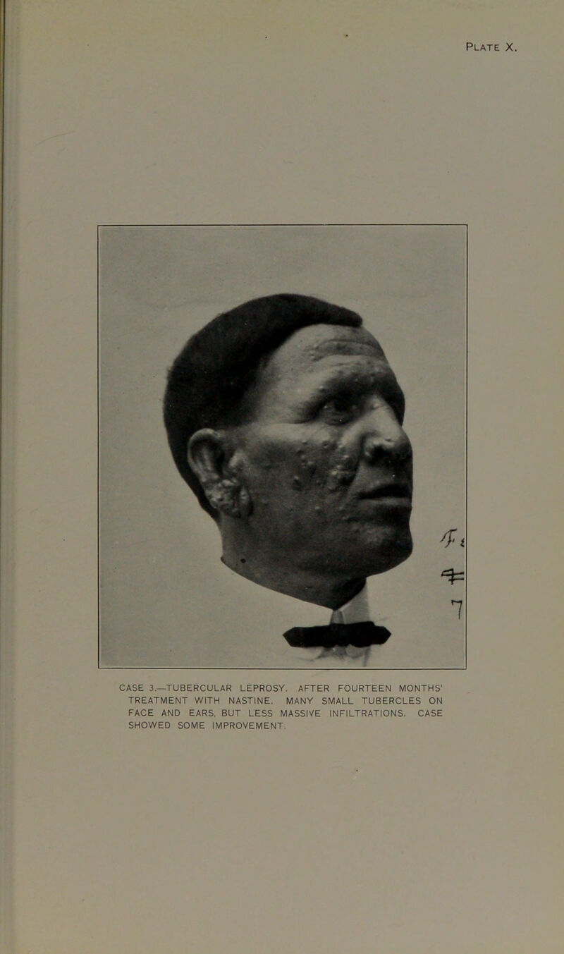 CASE 3.—TUBERCULAR LEPROSY. AFTER FOURTEEN MONTHS' TREATMENT WITH NASTINE. MANY SMALL TUBERCLES ON FACE AND EARS, BUT LESS MASSIVE INFILTRATIONS. CASE SHOWED SOME IMPROVEMENT.