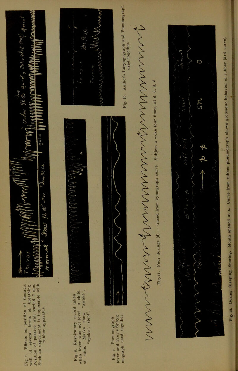 Fig. 12. Dozing, Sleeping, Snoring. Mouth opened at x,