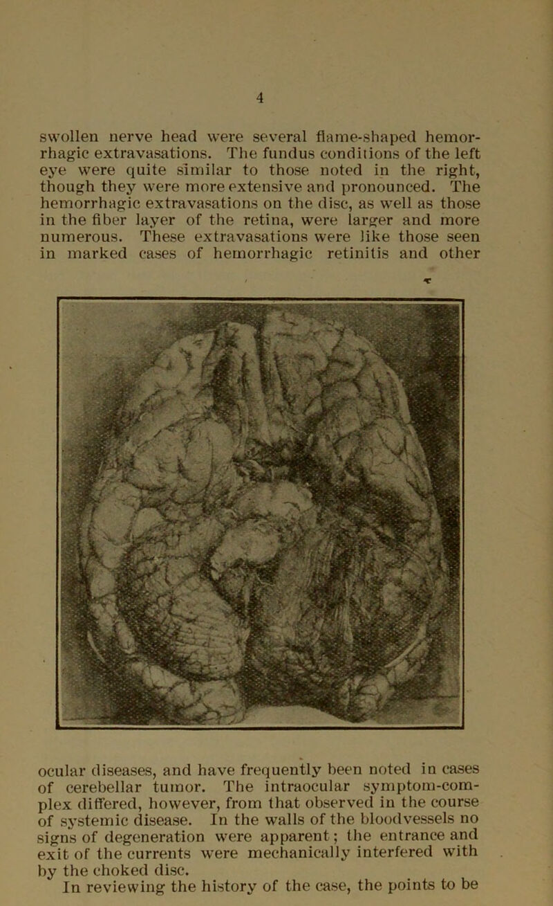 swollen nerve head were several flame-shaped hemor- rhagic extravasations. The fundus conditions of the left eye were quite similar to those noted in the right, though they were more extensive and pronounced. The hemorrhagic extravasations on the disc, as well as those in the fiber layer of the retina, were larger and more numerous. These extravasations were like those seen in marked cases of hemorrhagic retinitis and other ocular diseases, and have frequently been noted in cases of cerebellar tumor. The intraocular symptom-com- plex differed, however, from that observed in the course of systemic disease. In the walls of the bloodvessels no signs of degeneration were apparent; the entrance and exit of the currents were mechanically interfered with by the choked disc. In reviewing the history of the case, the points to be