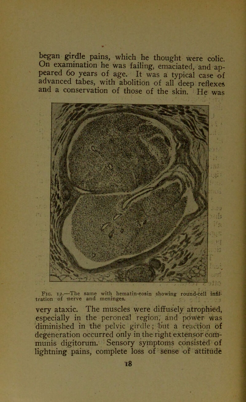 began girdle pains, which he thought were colic. On examination he was failing, emaciated, and ap- peared 6o years of age. It was a typical case of advanced tabes, with abolition of all deep reflexes and a conservation of those of the skin. He was Fig. 12.—The same with hematin-eosin showing round-cell infil- tration of -nerve and meninges. very ataxic. The muscles were diffusely atrophied, especially in the peroneal region, and power was diminished in the pelvic girdle; but a reaction of degeneration occurred only in the right extensor com- munis digitorum. Sensory symptoms consisted of lightning pains, complete loss of sense of attitude