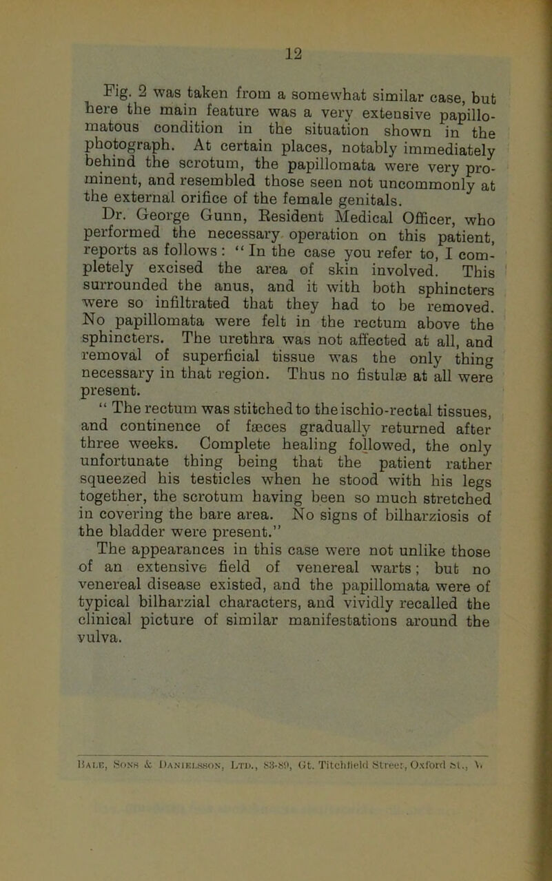 Fig. 2 was taken from a somewhat similar case, but here the main feature was a very extensive papillo- matous condition in the situation shown in the photograph. At certain places, notably immediately behind the scrotum, the papillomata were very pro- minent, and resembled those seen not uncommonly at the external orifice of the female genitals. Dr. George Gunn, Eesident Medical Officer, who performed the necessary operation on this patient, reports as follows: “In the case you refer to, I com- pletely excised the area of skin involved. This surrounded the anus, and it with both sphincters were so infiltrated that they had to be removed. No papillomata were felt in the rectum above the sphincters. The urethra was not affected at all, and removal of superficial tissue was the only thing necessary in that region. Thus no fistulse at all were present. “ The rectum was stitched to theischio-rectal tissues, and continence of faeces gradually returned after three weeks. Complete healing followed, the only unfortunate thing being that the patient rather squeezed his testicles when he stood with his legs together, the scrotum having been so much stretched in covering the bare area. No signs of bilharziosis of the bladder were present.” The appearances in this case were not unlike those of an extensive field of venereal warts; but no venereal disease existed, and the papillomata were of typical bilharzial characters, and vividly recalled the clinical picture of similar manifestations around the vulva. Hai.e, .Sonk cS: Daniki.s.son, Ltd., Gt. TitchlleUI Streer, Oxford st.,