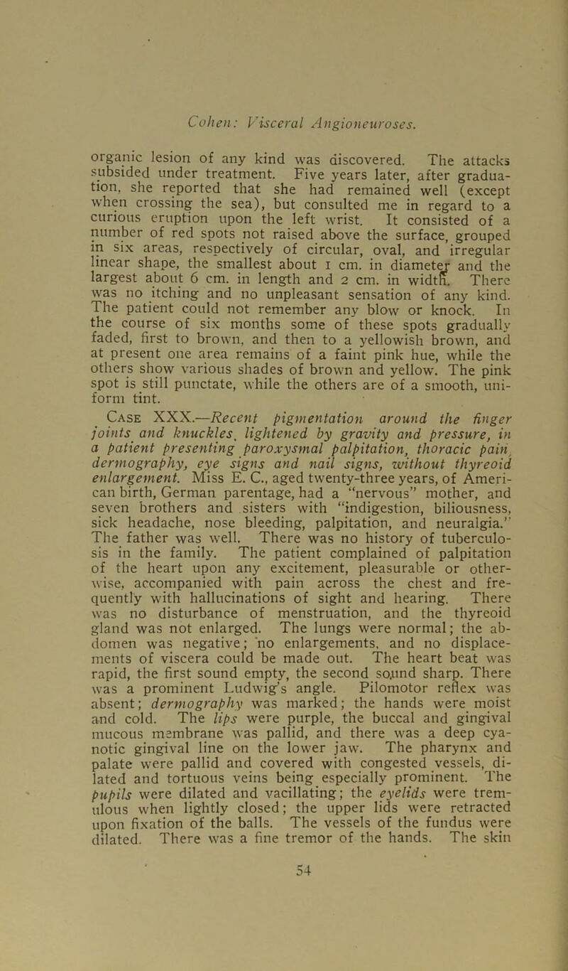 organic lesion of any kind was discovered. The attacks subsided under treatment. Five years later, after gradua- tion. she reported that she had remained well (except when crossing the sea), but consulted me in regard to a curious eruption upon the left wrist. It consisted of a number of red spots not raised above the surface, grouped in six areas, respectively of circular, oval, and irregular linear shape, the smallest about I cm. in diameter and the largest about 6 cm. in length and 2 cm. in width. There was no itching and no unpleasant sensation of any kind. The patient could not remember any blow or knock. In the course of six months some of these spots gradually faded, first to brown, and then to a yellowish brown, and at present one area remains of a faint pink hue, while the others show various shades of brown and yellow. The pink spot is still punctate, while the others are of a smooth, uni- form tint. Case XXX.—Recent pigmentation around the finger joints and knuckles. lightened by gravity and pressure, in a patient presenting paroxysmal palpitation, thoracic paint dermography, eye signs and nail signs, zvithout thyreoid enlargement. Miss E. C., aged twenty-three years, of Ameri- can birth, German parentage, had a “nervous” mother, and seven brothers and sisters with “indigestion, biliousness, sick headache, nose bleeding, palpitation, and neuralgia.” The father was well. There was no history of tuberculo- sis in the family. The patient complained of palpitation of the heart upon any excitement, pleasurable or other- wise, accompanied with pain across the chest and fre- quently with hallucinations of sight and hearing. There was no disturbance of menstruation, and the thyreoid gland was not enlarged. The lungs were normal; the ab- domen was negative; no enlargements, and no displace- ments of viscera could be made out. The heart beat was rapid, the first sound empty, the second so.und sharp. There was a prominent Ludwigs angle. Pilomotor reflex was absent; dermography was marked; the hands were moist and cold. The lips were purple, the buccal and gingival mucous membrane was pallid, and there was a deep cya- notic gingival line on the lower jaw. The pharynx and palate were pallid and covered with congested vessels,_ di- lated and tortuous veins being especially prominent. The pupils were dilated and vacillating; the eyelids were trem- ulous when lightly closed; the upper lids were retracted upon fixation of the balls. The vessels of the fundus were dilated. There was a fine tremor of the hands. The skin