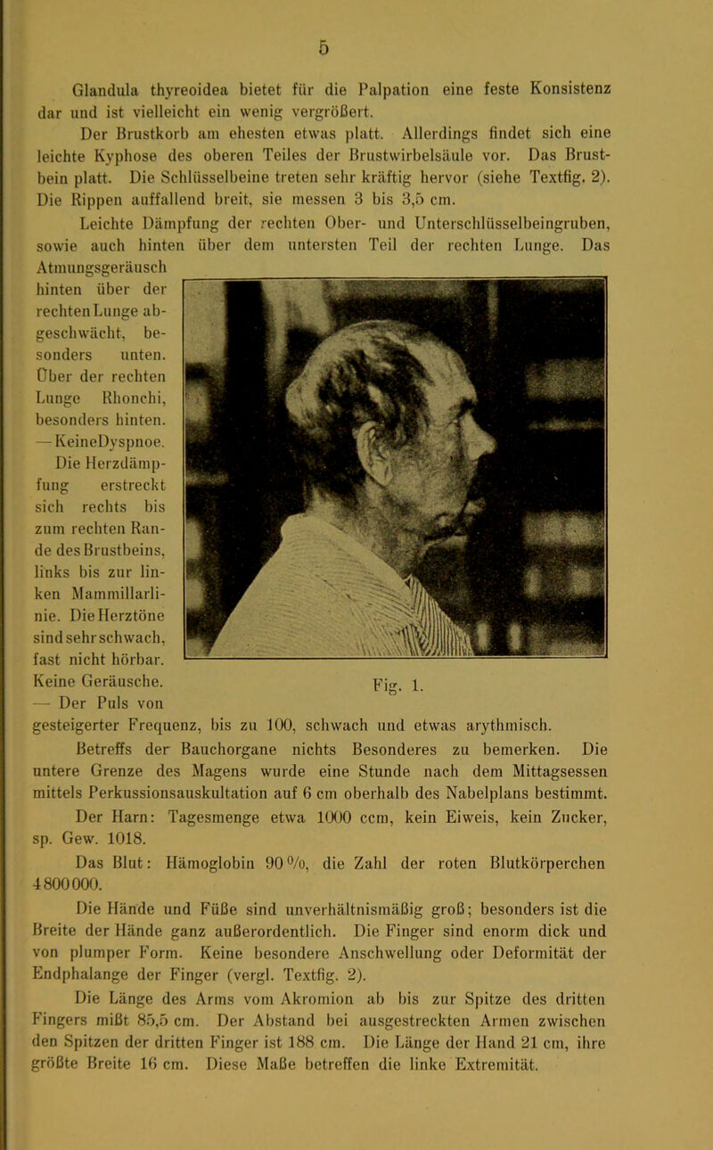 Glandula thyreoidea bietet für die Palpation eine feste Konsistenz dar und ist vielleicht ein wenig vergrößert. Der Brustkorb am ehesten etwas platt. Allerdings findet sich eine leichte Kyphose des oberen Teiles der Brustwirbelsäule vor. Das Brust- bein platt. Die Schlüsselbeine treten sehr kräftig hervor (siehe Textfig. 2). Die Rippen auffallend breit, sie messen 3 bis 3,5 cm. Leichte Dämpfung der rechten Ober- und Unterschlüsselbeingruben, sowie auch hinten über dem untersten Teil der rechten Lunge. Das Atmungsgeräusch hinten über der rechten Lunge ab- geschwächt, be- sonders unten. Über der rechten Lunge Rhonchi, besonders hinten. — KeineDyspnoe. Die Herzdämp- fung erstreckt sich rechts bis zum rechten Ran- de des Brustbeins, links bis zur lin- ken Mammillarli- nie. Die Herztöne sind sehr schwach, fast nicht hörbar. Keine Geräusche. — Der Puls von gesteigerter Frequenz, bis zu 100, schwach und etwas arythmisch. Betreffs der Bauchorgane nichts Besonderes zu bemerken. Die untere Grenze des Magens wurde eine Stunde nach dem Mittagsessen mittels Perkussionsauskultation auf 6 cm oberhalb des Nabelplans bestimmt. Der Harn: Tagesmenge etwa 1000 ccm, kein Ei weis, kein Zucker, sp. Gew. 1018. Das Blut: Hämoglobin 90 ^/o, die Zahl der roten Blutkörperchen 4800000. Die Hände und Füße sind unverhältnismäßig groß; besonders ist die Breite der Hände ganz außerordentlich. Die Finger sind enorm dick und von plumper Form. Keine besondere Anschwellung oder Deformität der Endphalange der Finger (vergl. Textfig. 2). Die Länge des Arms vom Akromion ab bis zur Spitze des dritten Fingers mißt 8.5,5 cm. Der Abstand bei ausgestreckten Armen zwischen den Spitzen der dritten Finger ist 188 cm. Die Länge der Hand 21 cm, ihre größte Breite 16 cm. Diese Maße betreffen die linke Extremität.