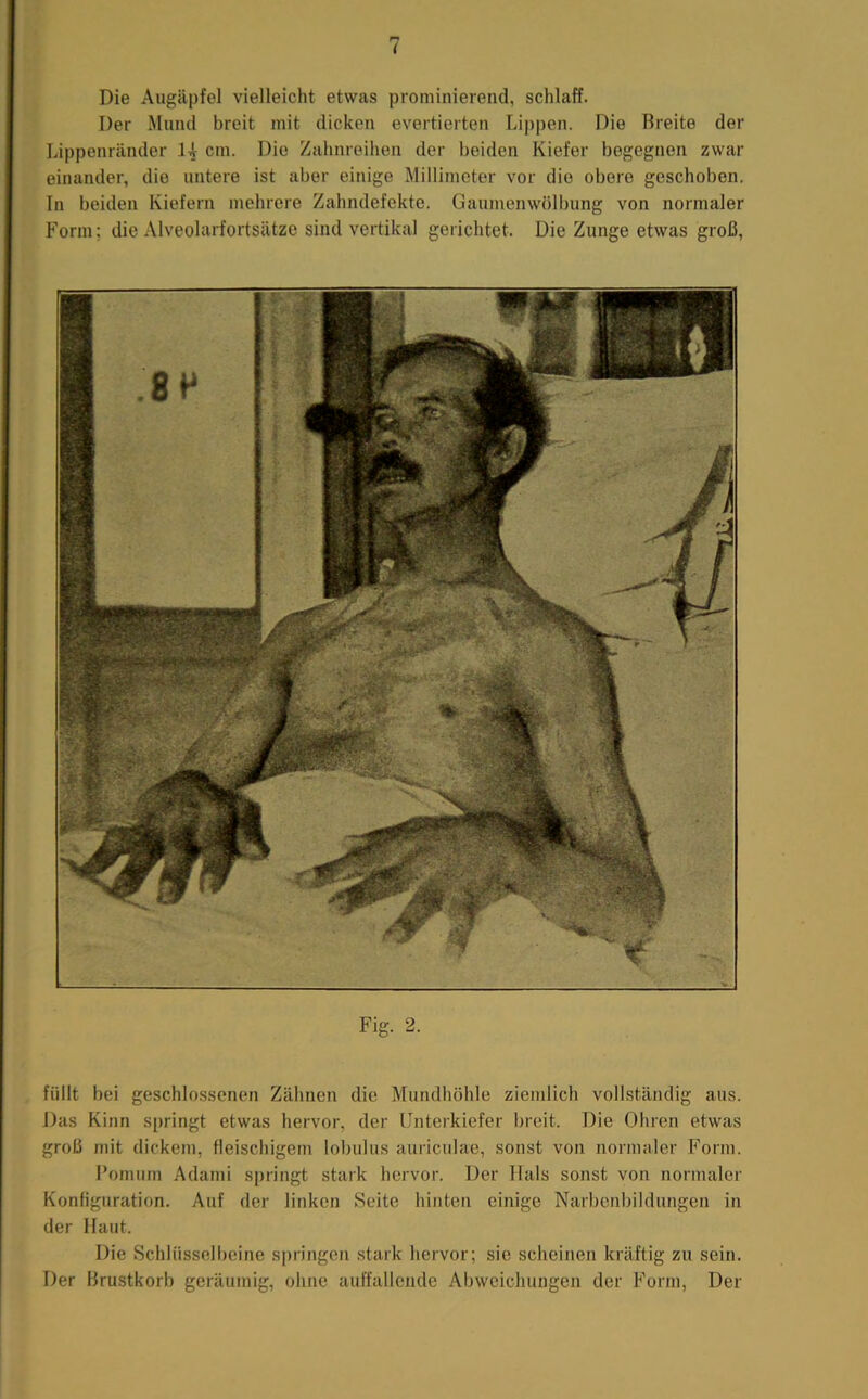 Die xXugäpfel vielleicht etwas prominierend, schlaff. Der Mund breit mit dicken evertierten Lippen. Die Breite der Lippenränder U cm. Die Zahnreihen der beiden Kiefer begegnen zwar einander, die untere ist aber einige Millimeter vor die obere geschoben. In beiden Kiefern mehrere Zahndefekte. Gaumenwölbung von normaler Form; die Alveolarfortsätze sind vertikal gerichtet. Die Zunge etwas groß. Fig. 2. füllt bei geschlossenen Zähnen die Mundhöhle ziemlich vollständig aus. Das Kinn springt etwas hervor, der Unterkiefer breit. Die Ohren etwas groß mit dickem, fleischigem lobulus auriculae, sonst von normaler Form. l’omum Adami springt stark hervor. Der Hals sonst von normaler Konfiguration. Auf der linken Seite hinten einige Narbenbildungen in der Haut. Die Schlüsselbeine springen .stark hervor; sie scheinen kräftig zu sein. Der Brustkorb geräumig, ohne auffallende Abweichungen der Form, Der