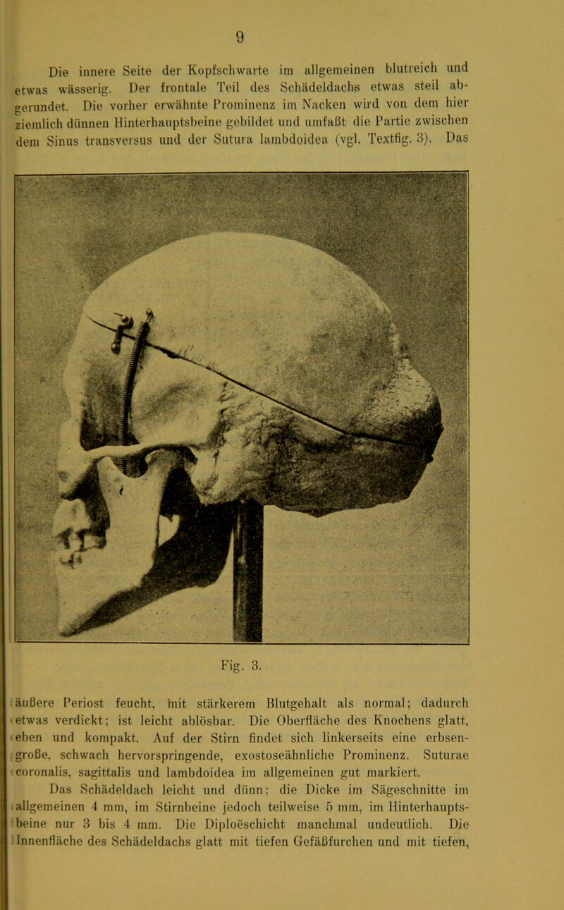 Die innere Seite der Kopfschwarte im allgemeinen blutreich und etwas wässerig. Der frontale Teil des Schädeldach« etwas steil ab- gerundet. Die vorher erwähnte Prominenz im Nacken wird von dem hier ziemlich dünnen Hinterhauptsbeine gebildet und umfal3t die Partie zwischen dem Sinus transversus und der Siitura lambdoidea (vgl. Textfig. B). Das Fig. 3. äußere Periost feucht, hiit stärkerem Blutgehalt als normal; dadurch etwas verdickt; ist leicht ablösbar. Die Oberfläche des Knochens glatt, eben und kompakt. Auf der Stirn findet sich linkerseits eine erbsen- große, schwach hervorspringende, exostoseähnliche Prominenz. Suturae coronalis, sagittalis und lambdoidea im allgemeinen gut markiert. Das Schädeldach leicht und dünn; die Dicke im Sägeschnitte im allgemeinen 4 mm, im Stirnbeine jedoch teilweise 5 mm, im Hinterhaupts- beine nur 3 bis 4 mm. Die Diploeschicht manchmal undeutlich. Die Innenfläche des Schädeldachs glatt mit tiefen Gefäßfurchen und mit tiefen.