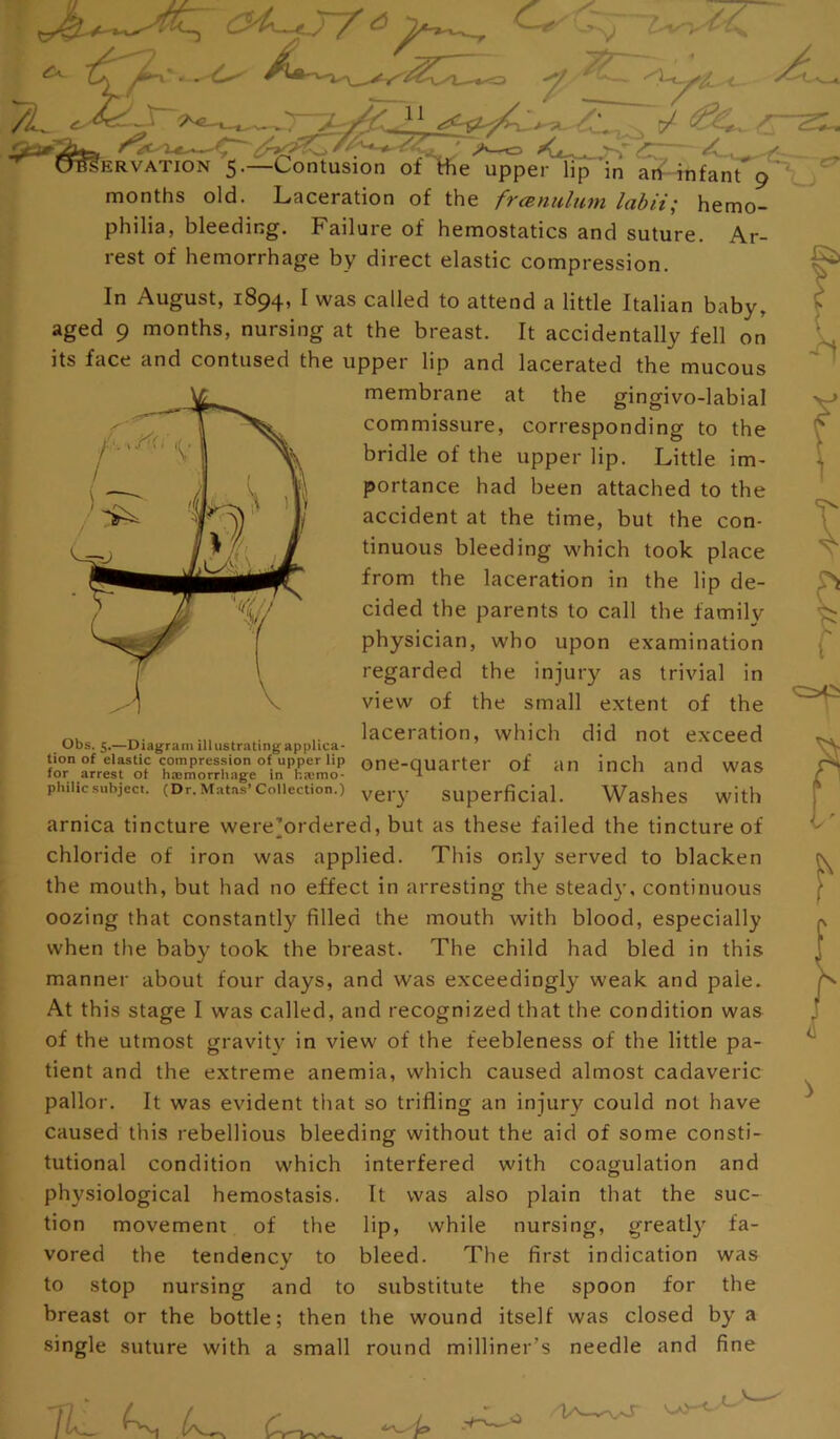 7L ^ r '‘'^^/i <- w c*— **''y cy^^'N«-> ' ' , -', Xv-. , ERVATiON 5,—Contusion of me upper lip in ari^infant''9 months old. Laceration of the frcBnidum labii; hemo- philia, bleeding. Failure of hemostatics and suture. Ar- rest of hemorrhage by direct elastic compression. In August, 1894, I was called to attend a little Italian baby, aged 9 months, nursing at the breast. It accidentally fell on its face and contused the upper lip and lacerated the mucous membrane at the gingivo-labial commissure, corresponding to the bridle of the upper lip. Little im- portance had been attached to the accident at the time, but the con- tinuous bleeding which took place from the laceration in the lip de- cided the parents to call the family physician, who upon examination regarded the injury as trivial in view of the small extent of the . .. laceration, which did not exceed one-quarter of an inch and was for arrest of haemorrhage in ha;mo* ^ ^ c* v* phihcsubject. (Dr. Matas’Collection.) ygj-y Superficial. WasheS with arnica tincture were’ordered, but as these failed the tincture of chloride of iron was applied. This only served to blacken the mouth, but had no effect in arresting the stead}’, continuous oozing that constantly filled the mouth with blood, especially when the baby took the breast. The child had bled in this manner about four days, and was exceedingly weak and pale. At this stage I was called, and recognized that the condition was of the utmost gravity in view of the feebleness of the little pa- tient and the extreme anemia, which caused almost cadaveric pallor. It was evident that so trifling an injury could not have caused this rebellious bleeding without the aid of some consti- tutional condition which interfered with coagulation and It was also plain that the suc- lip, while nursing, greatly fa- bleed. The first indication was substitute the spoon for the physiological hemostasis, tion movement of the vored the tendency to to stop nursing and to breast or the bottle; then the wound itself was closed by a single suture with a small round milliner’s needle and fine L.'