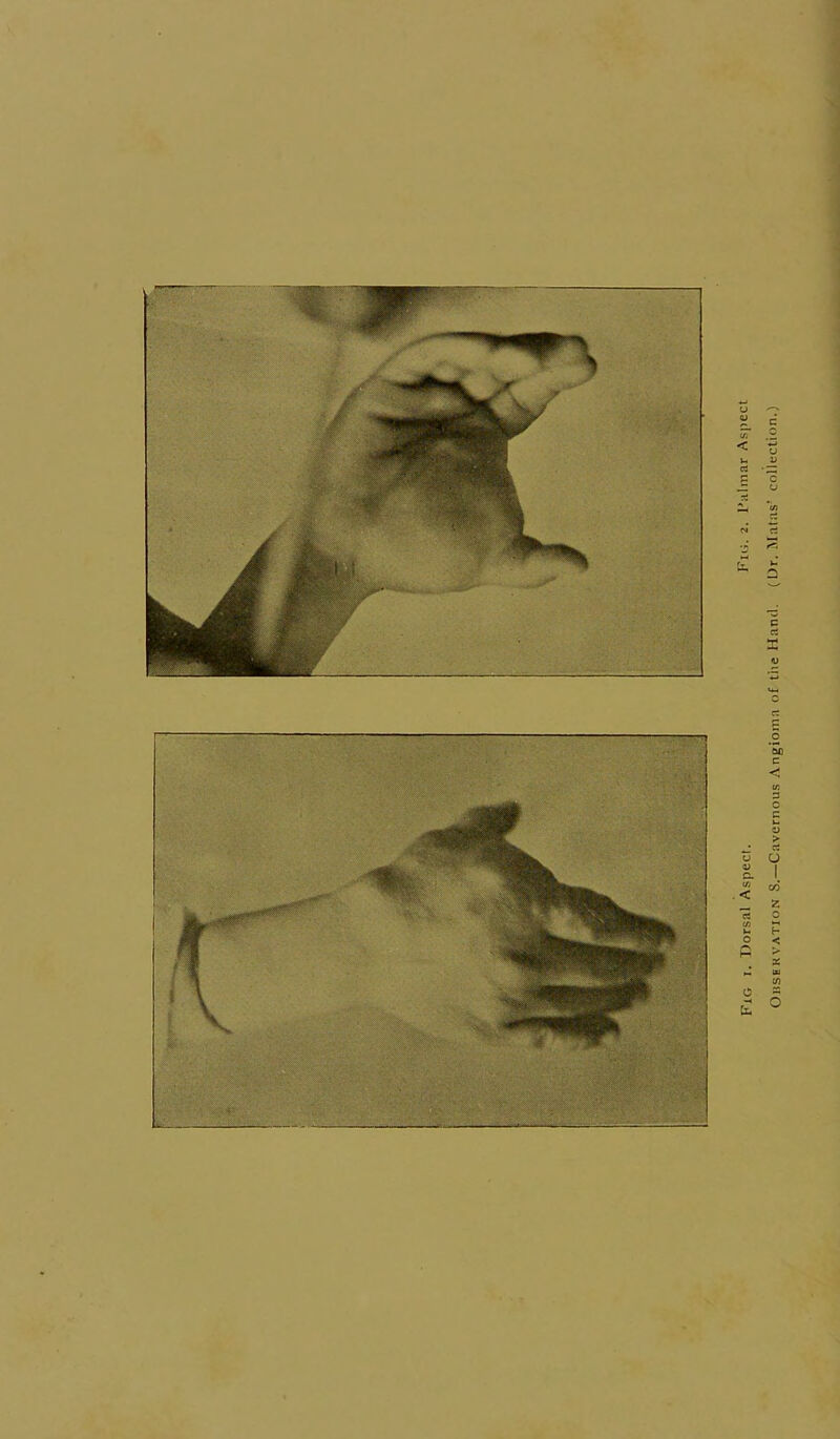 Fig I. Dorsal Aspect. Firt- 2- Falmar Aspect Ohsekvation S.—Cavernous Angioma of the Hand. (Dr. Matas’ collection.)