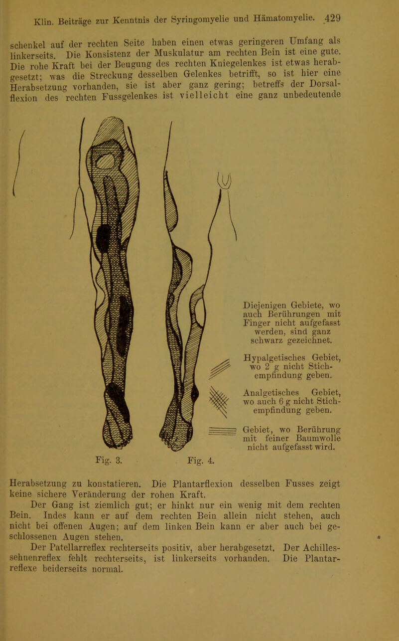 schenke! auf der rechten Seite haben einen etwas geringeren Umfang als linkerseits. Die Konsistenz der Muskulatur am rechten Bein ist eine gute. Die rohe Kraft bei der Beugung des rechten Kniegelenkes ist etwas herab- gesetzt; was die Streckung desselben Gelenkes betrifft, so ist hier eine Herabsetzung vorhanden, sie ist aber ganz gering; betreffs der Dorsal- flexion des rechten Fussgelenkes ist vielleicht eine ganz unbedeutende Fig. 3. Dieienigen Gebiete, wo auch Berührungen mit Finger nicht aufgefasst werden, sind ganz schwarz gezeichnet. Hypalgetisches Gebiet, wo 2 g nicht Stich- empfindung geben. Analgetisches Gebiet, wo auch 6 g nicht Stich- empfindung geben. Gebiet, wo Berührung mit feiner Baumwolle nicht aufgefasst wird. Fig. 4. Herabsetzung zu konstatieren. Die Plantarflexion desselben Fusses zeigt keine sichere Veränderung der rohen Kraft. Der Gang ist ziemlich gut; er hinkt nur ein wenig mit dem rechten Bein. Indes kann er auf dem rechten Bein allein nicht stehen, auch nicht bei offenen Augen; auf dem linken Bein kann er aber auch bei ge- schlossenen Augen stehen. Der Patellarreflex rechterseits positiv, aber herabgesetzt. Der Achilles- sehnenreflex fehlt rechterseits, ist linkerseits vorhanden. Die Plantar- reflexe beiderseits normal.