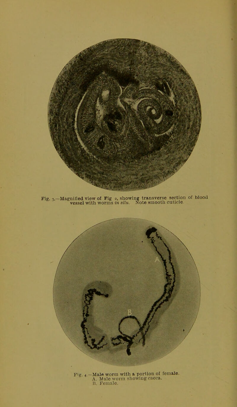 vessel with worms in sitn. Note smooth cuticle. Fig 4 -Male worm with a portion of female. A. Male worm showing caeca. B. Female.