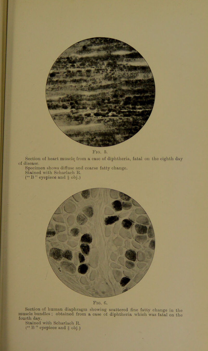 Pig. 5. Section of heart muscle from a case of diphtheria, fatal on the eighth day of disease. Specimen shows diffuse and coarse fatty change. Stained with Scharlach R. (“ B ” eyepiece and | obj.) Fig. G. Section of human diaphragm showing scattered fine fatty change in the muscle bundles ; obtained from a case of diphtheria which was fatal on the fourth day. Stained with Scharlach R.