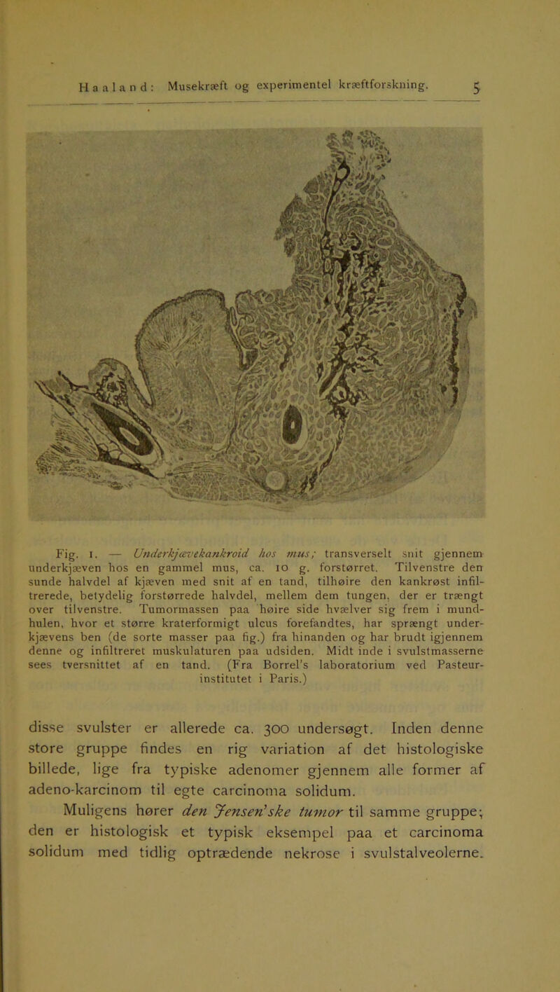 Fig. i. — Underkjævekankroid hos mus; transverselt snit gjennem underkjæven hos en gammel mus, ca. io g. forstørret. Tilvenstre den sunde halvdel af kjæven med snit af en tand, tilhøire den kankrøst infil- trerede, betydelig forstørrede halvdel, mellem dem tungen, der er trængt over tilvenstre. Tumormassen paa høire side hvælver sig frem i mund- hulen, hvor et større kraterformigt ulcus forefandtes, har sprængt under- kjævens ben (de sorte masser paa fig.) fra hinanden og har brudt igjennem denne og infiltreret muskulaturen paa udsiden. Midt inde i svulst masserne sees tversnittet af en tand. (Fra Borrel’s laboratorium ved Pasteur- institutet i Paris.) disse svulster er allerede ca. 300 undersøgt. Inden denne store gruppe findes en rig variation af det histologiske billede, lige fra typiske adenomer gjennem alle former af adeno-karcinom til egte carcinoma solidum. Muligens hører den Jensen’ske tumor til samme gruppe; den er histologisk et typisk eksempel paa et carcinoma solidum med tidlig optrædende nekrose i svulstalveolerne.