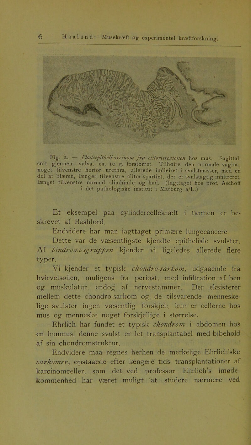 Fig. 2. — PlacUepithelkarcinom fra clitorisregiouen hos mus. Sagittal- snit gjennem vulva, ca. io g. forstørret. Tilhøire den normale vagina, noget tilvenstre herfor urethra, allerede indleiret i svulstmasser, med en del af blæren, længer tilvenstre clitorispartiet, der er svulstagtig infiltreret, længst tilvenstre normal slimhinde og hud. (Iagttaget hos prof. Aschoff i det pathologiske institut i Marburg a/L.) Et eksempel paa cylindercellekræft i tarmen er be- skrevet af Bashford. Endvidere har man iagttaget primære lungecancere Dette var de væsentligste kjendte epitheliale svulster. Af bindevævsgruppen kjender vi ligeledes allerede flere typer. Vi kjender et typisk chondro-sarkom, udgaaende fra hvirvelsøjlen, muligens fra periost, med infiltration af ben og muskulatur, endog af nervestammer. Der eksisterer mellem dette chondro-sarkom og. de tilsvarende menneske- lige svulster ingen væsentlig forskjel; kun er cellerne hos mus og menneske noget forskjellige i størrelse. Ehrlich har fundet et typisk chondrom i abdomen hos en hunmus, denne svulst er let transplantabel med bibehold af sin chondromstruktur. Endvidere maa regnes herhen de merkelige Ehrlich’ske sarkomer, opstaaede efter længere tids transplantationer af karcinomceller, som det ved professor Ehrlich’s imøde- kommenhed har været muligt at studere nærmere ved