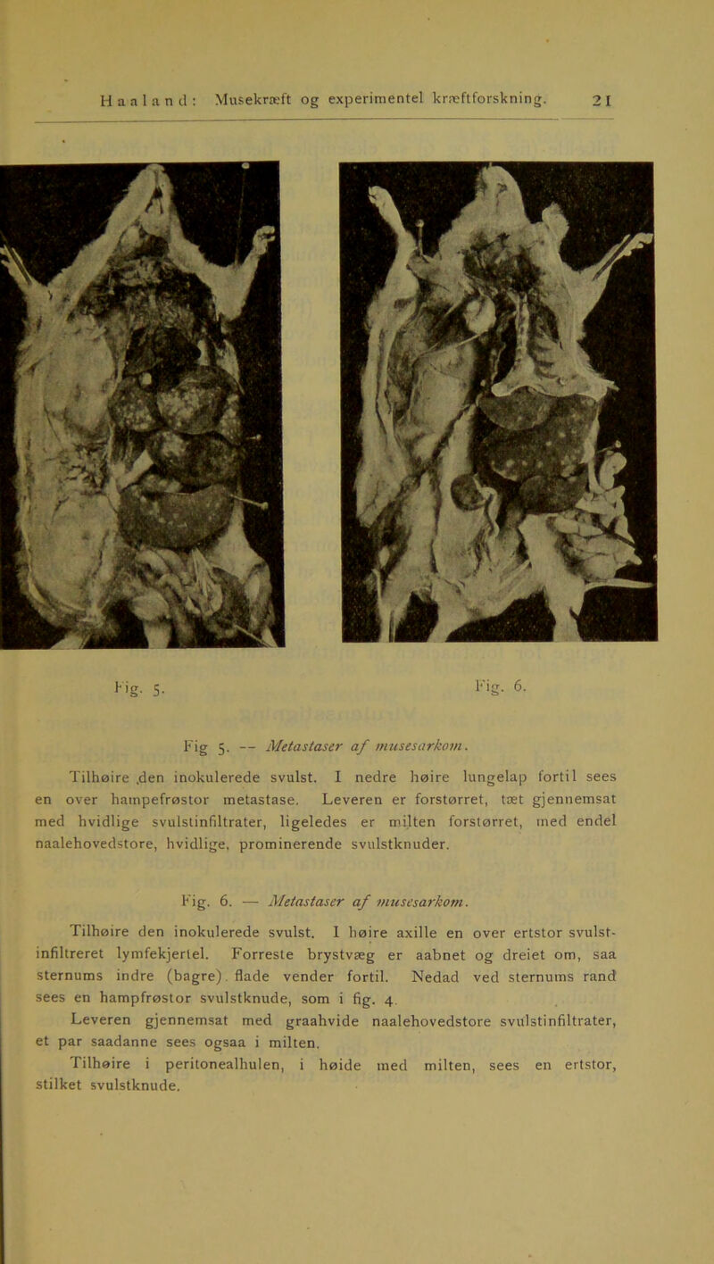 1‘ig- S- Kig. 6. Kig 5. — Metastaser af musesarkom. Tilhøire .den inokulerede svulst. I nedre høire lungelap fortil sees en over hainpefrøstor metastase. Leveren er forstørret, tæt gjennemsat med hvidlige svulslinfiltrater, ligeledes er milten forstørret, tned endel naalehovedstore, hvidlige, prominerende svulstknuder. Kig. 6. — Metastaser af musesarkom. Tilhøire den inokulerede svulst. 1 høire axille en over ertstor svulst- infiltreret lymfekjertel. Forreste brystvæg er aabnet og dreiet om, saa sternums indre (bagre). flade vender fortil. Nedad ved sternums rand sees en hampfrøstor svulstknude, som i fig. 4 Leveren gjennemsat med graahvide naalehovedstore svulstinfiltrater, et par saadanne sees ogsaa i milten. Tilhøire i peritonealhulen, i høide med milten, sees en ertstor, stilket svulstknude.