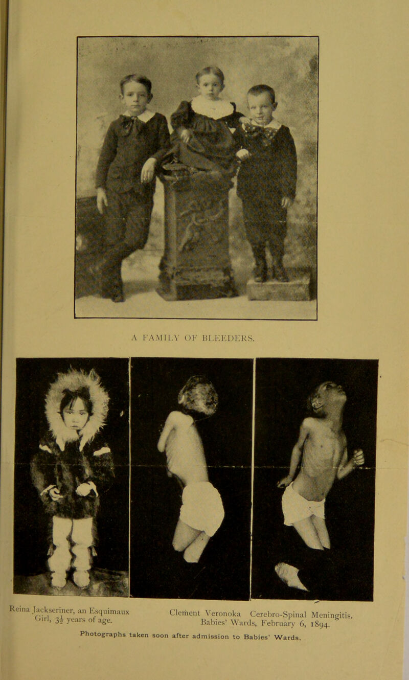 A FAMILY OF HI.KF.DFRS. Keina Jackseriner, an F:sc|uimaux yi-‘ars of age. Clement Veronoka Cerehro-Spinal Meningitis. Babies’ W'ards, k'ebruary 6, 1894. Photographs taken soon after admission to Babies’ Wards.