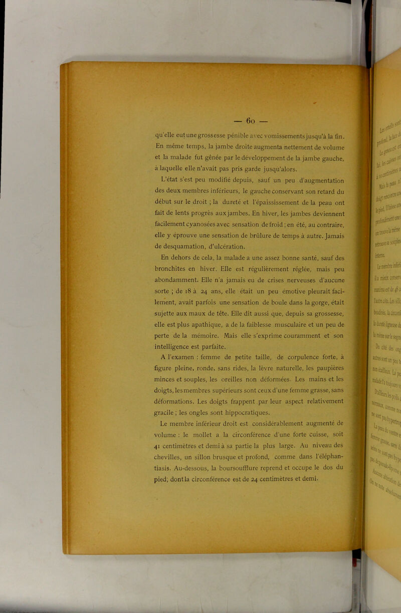 qu’elle eut une grossesse pénible avec vomissements jusqu’à la fin. En même temps, la jambe droite augmenta nettement de volume et la malade fut gênée par le développement de la jambe gauche, à laquelle elle n’avait pas pris garde jusqu’alors. L’état s’est peu modifié depuis, sauf un peu d’augmentation des deux membres inférieurs, le gauche conservant son retard du début sur le droit ; la dureté et l’épaississement de la peau ont fait de lents progrès aux jambes. En hiver, les jambes deviennent facilement cyanosées avec sensation de froid; en été, au contraire, elle y éprouve une sensation de brûlure de temps à autre. Jamais de desquamation, d’ulcération. En dehors de cela, la malade a une assez bonne santé, sauf des bronchites en hiver. Elle est régulièrement réglée, mais peu abondamment. Elle n’a jamais eu de crises nerveuses d’aucune sorte ; de i8 à 24 ans, elle était un peu émotive pleurait faci- lement, avait parfois une sensation de boule dans la gorge, était sujette aux maux de tête. Elle dit aussi que, depuis sa grossesse, elle est plus apathique, a de la faiblesse musculaire et un peu de perte de la mémoire. Mais elle s'exprime couramment et son intelligence est parfaite. A l’examen : femme de petite taille, de corpulence forte, à figure pleine, ronde, sans rides, la lèvre naturelle, les paupières minces et souples, les oreilles non déformées. Les mains et les doigts, les membres supérieurs sont ceux d’une femme grasse, sans déformations. Les doigts frappent par leur aspect relativement gracile ; les ongles sont hippocratiques. Le membre inférieur droit est considérablement augmenté de volume : le mollet a la circonférence d’une forte cuisse, soit 41 centimètres et demi à sa partie la plus large. Au niveau des chevilles, un sillon brusque et profond, comme dans l’éléphan- tiasis. Au-dessous, la boursoufflure reprend et occupe le dos du pied; dontla circonférence est de 24 centimètres et demi.