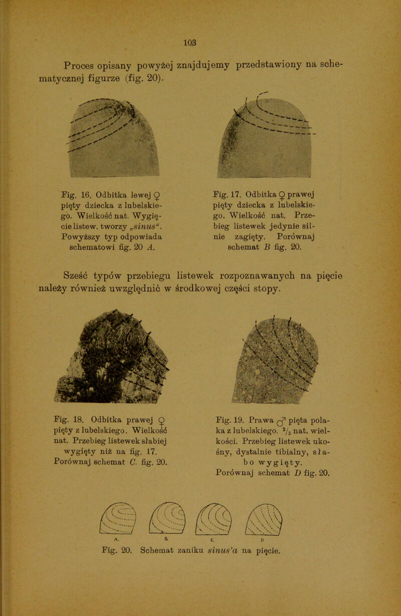 Proces opisany powyżej znajdujemy przedstawiony na sche- matycznej figurze (fig. 20). Fig. 16. Odbitka lewej Q pięty dziecka z lubelskie- go. Wielkość nat. Wygię- cie listew. tworzy „sinus“. Powyższy typ odpowiada schematowi fig. 20 A. Fig. 17. Odbitka ę prawej pięty dziecka z lubelskie- go. Wielkość nat. Prze- bieg listewek jedynie sil- nie zagięty. Porównaj schemat B fig. 20. Sześć typów przebiegu listewek rozpoznawanych na pięcie należy również uwzględnić w środkowej części stopy. Fig. 18. Odbitka prawej ę pięty z lubelskiego. Wielkość nat. Przebieg listewek słabiej wygięty niż na fig. 17. Porównaj schemat C. fig. 20. Fig. 19. Prawa ęj71 pięta pola- ka z lubelskiego. 2/3 nat. wiel- kości. Przebieg listewek uko- śny, dystalnie tibialny, sła- bo wygięty. Porównaj schemat D fig. 20. A. B. c. o Fig. 20. Schemat zaniku sinus’a na pięcie.