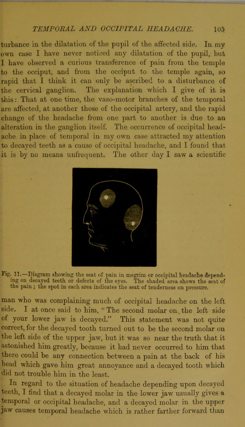 turbance in the dilatation of the pupil of the affected side. In my own case I have never noticed any dilatation of the pupil, but I have observed a curious transference of pain from the temple to the occiput, and from the occiput to the temple again, so rapid that I think it can only be ascribed to a disturbance of the cervical ganglion. The explanation which I give of it is this: That at one time, the vaso-motor branches of the temporal are affected, at another those of the occipital artery, and the rapid change of the headache from one part to another is due to an alteration in the ganglion itself. The occurrence of occipital head- ache in place of temporal in my own case attracted my attention to decayed teeth as a cause of occipital headache, and I found that it is by no means unfrequent. The other day I saw a scientific Fig. 11.—Diagram showing the seat of pain in megrim or occipital headache depend- ing on decayed teeth or defects of the eyes. The shaded area shows the seat of the pain; the spot in each area indicates the seat of tenderness on pressure. man who was complaining much of occipital headache on the left side. I at once said to him, “ The second molar on the left side of your lower jaw is decayed.” This statement was not quite correct, for the decayed tooth turned out to be the second molar on the left side of the upper jaw, but it was so near the truth that it astonished him greatly, because it had never occurred to him that there could be any connection between a pain at the back of his head which gave him great annoyance and a decayed tooth which did not trouble him in the least. In regard to the situation of headache depending upon decayed teeth, I find that a decayed molar in the lower jaw usually gives a temporal or occipital headache, and a decayed molar in the upper jaw causes temporal headache which is rather farther forward than