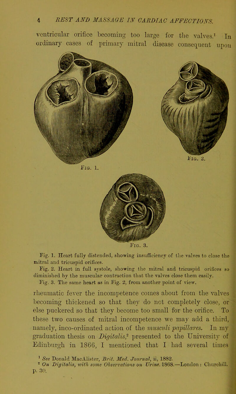 ventricular orifice becoming too large for the valves.1 In ordinary cases of primary mitral disease consequent upon Fig. 3. Fig. 1. Heart fully distended, showing insufficiency of the valves to close the mitral and tricuspid orifices. Fig. 2. Heart in full systole, showing the mitral and tricuspid orifices so diminished by the muscular contraction that the valves close them easily. Fig. 3. The same heart as in Fig. 2, from another point of view. rheumatic fever the incompetence comes about from the valves becoming thickened so that they do net completely close, or else puckered so that they become too small for the orifice. To these two causes of mitral incompetence we may add a third, namely, inco-ordinated action of the muscvli papillares. In my graduation thesis on Digitalispresented to the University of Edinburgh in 1866, I mentioned that I had several times 1 See Donald MacAlister, Brit. Med. Journal, ii, 1882. 1 On Digitalis, with some Observations on Urine. 1868.—London: Churchill, p. 30.