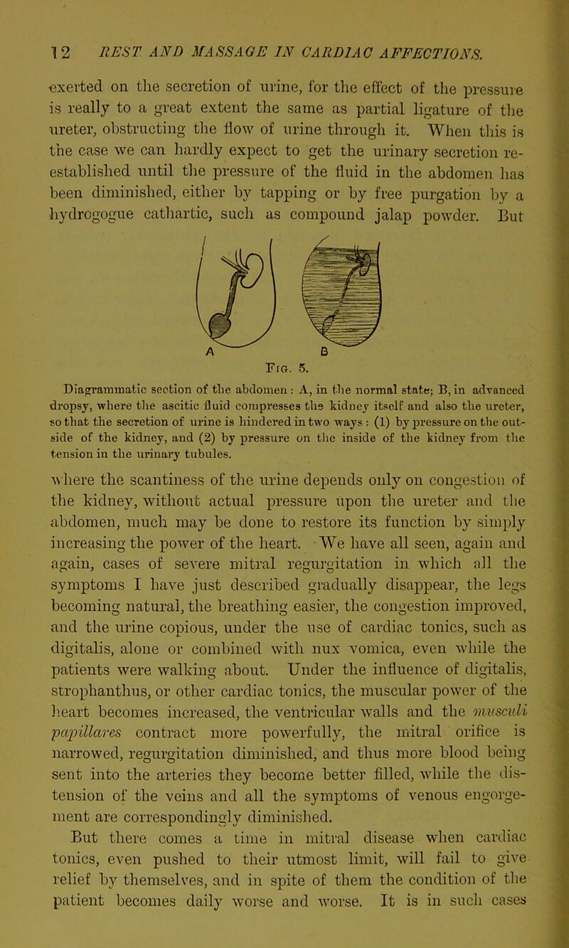 exerted on the secretion of urine, for the effect of the pressure is really to a great extent the same as partial ligature of the ureter, obstructing the flow of urine through it. When this is the case we can hardly expect to get the urinary secretion re- established until the pressure of the fluid in the abdomen lias been diminished, either by tapping or by free purgation by a hydrogogue cathartic, such as compound jalap powder. But Diagrammatic section of the abdomen : A, in the normal state; B, in advanced dropsy, where the ascitic fluid compresses the kidney itself and also the ureter, so that the secretion of urine is hindered in two ways : (1) by pressure on the out- side of the kidney, and (2) by pressure on the inside of the kidney from the tension in the urinary tubules. where the scantiness of the urine depends only on congestion of the kidney, without actual pressure upon the ureter and the abdomen, much may he done to restore its function by simply increasing the power of the heart. We have all seen, again and again, cases of severe mitral regurgitation in which all the symptoms I have just described gradually disappear, the legs becoming natural, the breathing easier, the congestion improved, and the urine copious, under the use of cardiac tonics, such as digitalis, alone or combined with nux vomica, even while the patients were walking about. Under the influence of digitalis, strophanthus, or other cardiac tonics, the muscular power of the heart becomes increased, the ventricular walls and the musculi pap Marcs contract more powerfully, the mitral orifice is narrowed, regurgitation diminished, and thus more blood being sent into the arteries they become better filled, while the dis- tension of the veins and all the symptoms of venous engorge- ment are correspondingly diminished. But there comes a time in mitral disease when cardiac tonics, even pushed to their utmost limit, will fail to give relief by themselves, and in spite of them the condition of the patient becomes daily worse and worse. It is in such cases