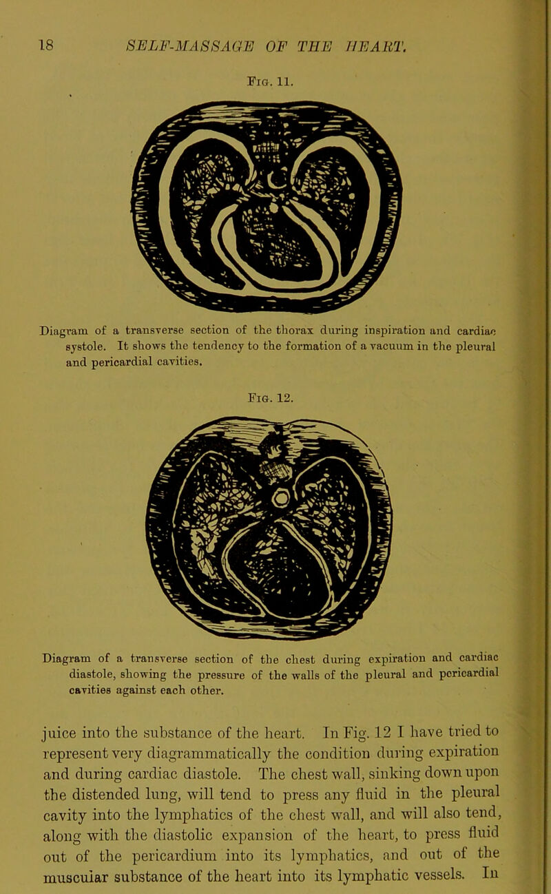 Fig. 11. Diagram of a transverse section of the thorax during inspiration and cardiac systole. It shows the tendency to the formation of a vacuum in the pleural and pericardial cavities. Fig. 12. Diagram of a transverse section of the chest during expiration and cardiac diastole, showing the pressure of the walls of the pleural and pericardial cavities against each other. juice into the substance of the heart. In Fig. 12 I have tried to represent very diagrammatically the condition during expiration and during cardiac diastole. The chest wall, sinking down upon the distended lung, will tend to press any fluid in the pleural cavity into the lymphatics of the chest wall, and will also tend, along with the diastolic expansion of the heart, to press fluid out of the pericardium into its lymphatics, and out of the muscular substance of the heart into its lymphatic vessels. In