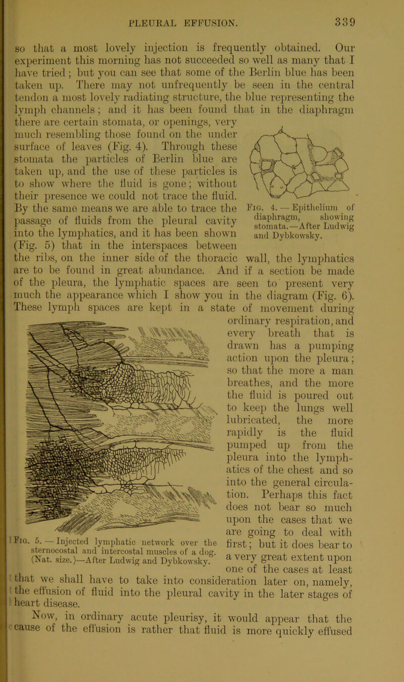 so that a most lovely injection is frequently obtained. Our experiment this morning has not succeeded so well as many that I have tried; but you can see that some of tlie Berlin blue has been taken up. There may not unfrequently be seen in the central tendon a most lovely radiating structure, the blue representing tbe lymph channels; and it has been found that in the diaphragm there are certain stomata, or openings, very much resembling those found on the under surface of leaves (Fig. 4). Through these stomata the particles of Berlin blue are taken up, and the use of these particles is to show where the fluid is gone; without their presence we could not trace the fluid. By the same means we are able to trace the Fig. 4. — Epithelium of passage of liuids from the pleural cavity diaphragm showing into the lymphatics, and it has been shown and Dybkowsky. (Fig. 5) that in the interspaces between the ribs, on the inner side of the thoracic wall, the lymphatics are to be found in great abundance. And if a section be made of the pleura, the lymphatic spaces are seen to present very much the appearance which I show you in the diagram (Fig. 6). These lymph spaces are kept in a state of movement during ordinary respiration, and every breath that is drawn has a pumping action upon the pleura; so that the more a man breathes, and the more the fluid is poured out to keep the lungs well lubricated, the more rapidly is the fluid pumped up from the pleura into the lymph- atics of the chest and so into the general circula- tion. Perhaps this fact does not bear so much upon the cases that we are going to deal witli first; but it does bear to a very great extent upon one of the cases at least . that we shall have to take into consideration later on, namely, | the effusion of fluid into the pleural cavity in the later stages of heart disease. Now, in ordinary acute pleurisy, it would appear that the cause of the effusion is rather that fluid is more quickly effused 1 Fio. 5. — Injected lymphatic network over tlie sternocostal and intercostal muscles of a dog. (Nat. size.)—After Ludwig and Dybkowsky.