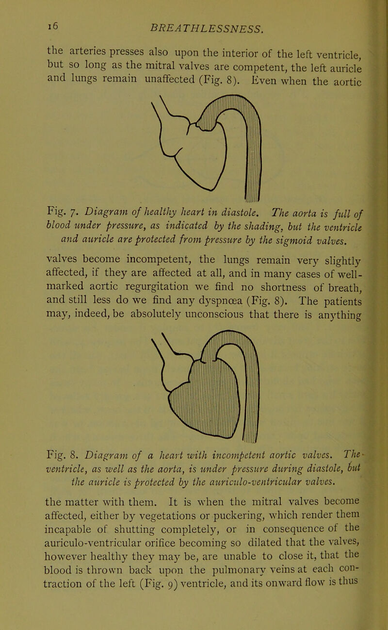 the cirteries presses also upon the interior of the left ventricle, but so long as the mitral valves are competent, the left auricle and lungs remain unaffected (Fig. 8). Even when the aortic Fig. 7. Diagram of healthy heart in diastole. The aorta is full of blood under pressure, as indicated by the shading, but the ventricle and auricle are protected from pressure by the sigmoid valves. valves become incompetent, the lungs remain very slightly affected, if they are affected at all, and in many cases of well- marked aortic regurgitation we find no shortness of breath, and still less do we find any dyspnoea (Fig. 8). The patients may, indeed, be absolutely unconscious that there is anything Fig. 8. Diagram of a heart with incompetent aortic valves. The' ventricle, as well as the aorta, is imder pressure during diastole, 6ut the auricle is protected by the auriculo-ventricular valves. the matter with them. It is when the mitral valves become affected, either by vegetations or puckering, which render them incapable of shutting completely, or in consequence of the auriculo-ventricular orifice becoming so dilated that the valves, however healthy they may be, are unable to close it, that the blood is thrown back upon the pulmonary veins at each con- traction of the left (Fig. 9) ventricle, and its onward flow is thus
