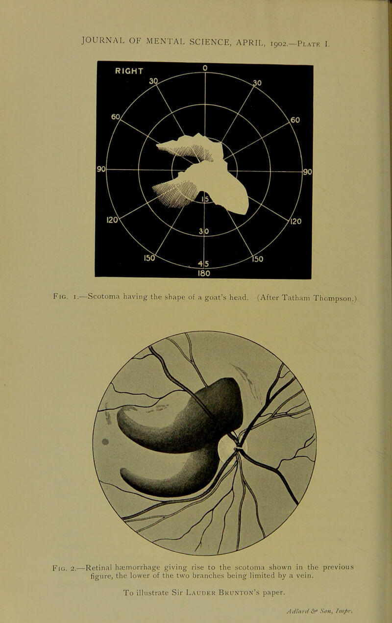 JOURNAL OF MENTAL SCIENCE, APRIL, 1902.—Plate I. Fig. 1.—Scotoma having the shape of a goat’s head. (After Tatham Thompson.) Fig. 2.—Retinal haemorrhage giving rise to the scotoma shown in the previous figure, the lower of the two branches being limited by a vein. To illustrate Sir Lauder Bkunton's paper. Adlnrd &“ Sou, Iw/»\