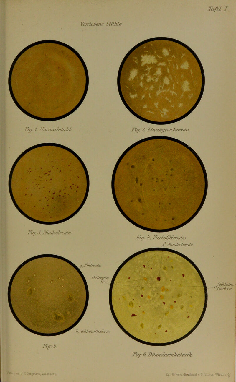 Verriebene. StüJile Fi^. i. JVorrnalntuAl Fig. 2, Bindegefvebsrestn- Fig.5. von J.p. Bergnidtin^ V/msboden. Fig. ^ K(tr‘Lofp^lreste. ?liiskebe3te ■SMeirrv^ flockejv Fiff^. 6j DünndarrrikcctarrJv I^l. Univers -ß™ckerci v. ll.Stürcz, Würzburg. h, •'in/iUmtßocJii’e, Fi^. 2, MufikeJreshe. q-FeHreste Fciinwle