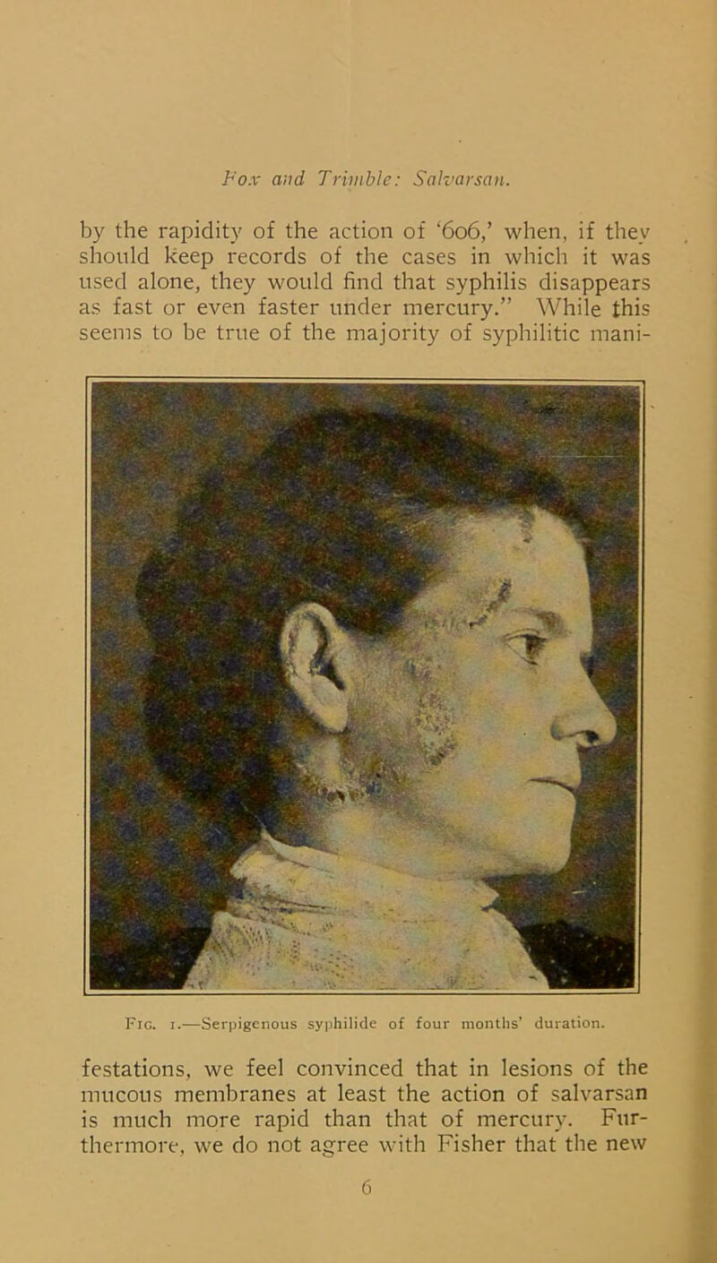 by the rapidity of the action of ‘606,’ when, if they should keep records of the cases in which it was used alone, they would find that syphilis disappears as fast or even faster under mercury.” While this seems to be true of the majority of syphilitic mani- Fic. 1.—Serpigenous syphilide of four months’ duration. festations, we feel convinced that in lesions of the mucous membranes at least the action of salvarsan is much more rapid than that of mercury. Fur- thermore, we do not agree with Fisher that the new