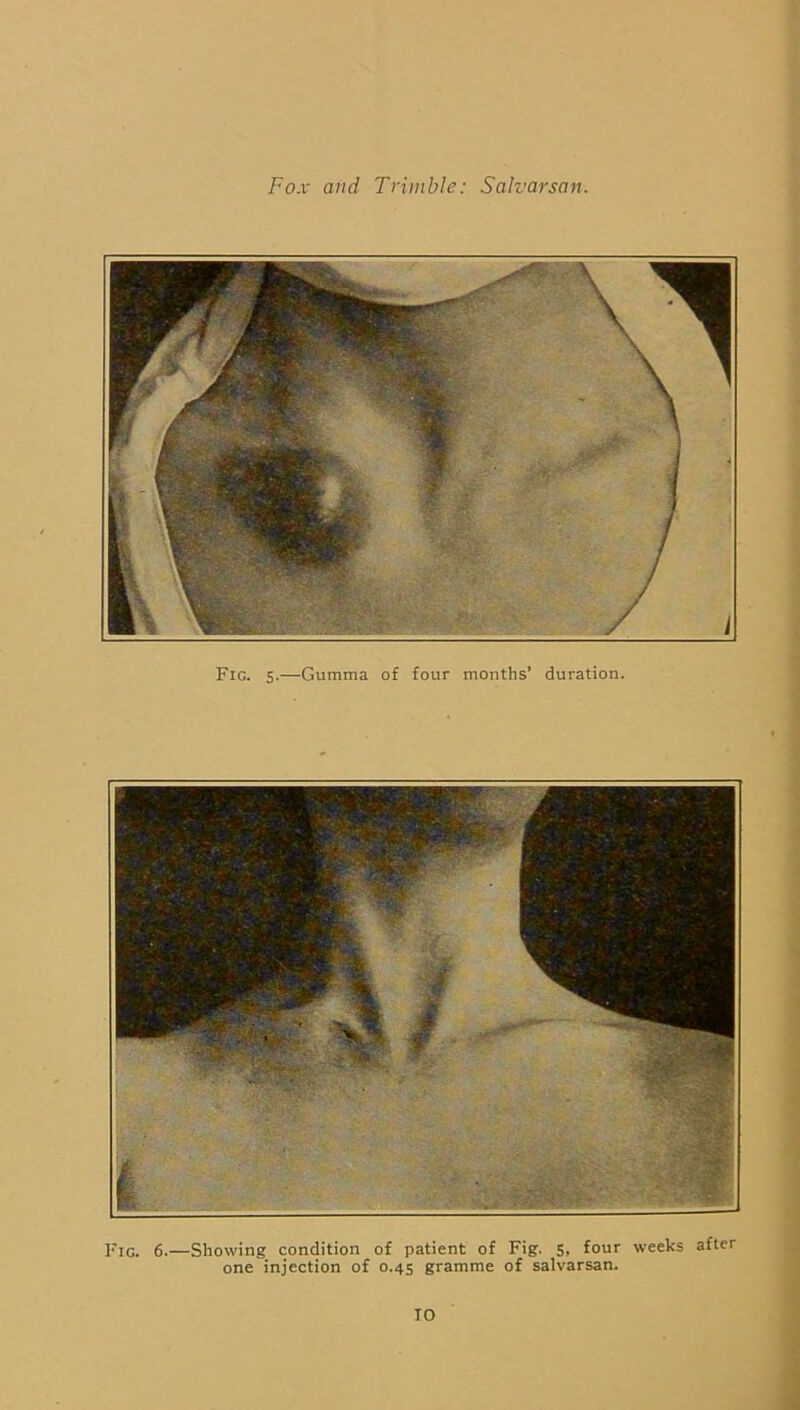 Fig. 5.—Gumma of four months’ duration. Fig. 6.—Showing condition of patient of Fig. 5, four weeks after one injection of 0.45 gramme of salvarsan.