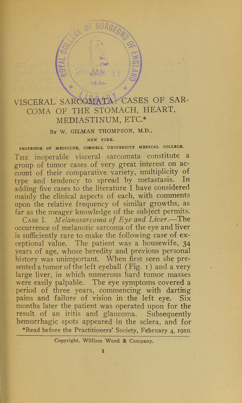 VISCERAL SARCOMATA: CASES OF SAR- COMA OF THE STOMACH, HEART, MEDIASTINUM, ETC * By W. GILMAN THOMPSON, M.D., NEW YORK. PROFESSOR OF MEDICINE, CORNELL UNIVERSITY MEDICAL COLLEGE. The inoperable visceral sarcomata constitute a group of tumor cases of very great interest on ac- count of their comparative variety, multiplicity of type and tendency to spread by metastasis. In adding five cases to the literature I have considered mainly the clinical aspects of each, with comments upon the relative frequency of similar growths, as far as the meager knowledge of the subject permits. Case I. Melanosarcoma of Eye and Liver.—The occurrence of melanotic sarcoma of the eye and liver is sufficiently rare to make the following case of ex- ceptional value. The patient was a housewife, 34 years of age, whose heredity and previous personal history was unimportant. When first seen she pre- sented a tumor of the left eyeball (Fig. 1) and a very large liver, in which numerous hard tumor masses were easily palpable. The eye symptoms covered a period of three years, commencing with darting pains and failure of vision in the left eye. Six months later the patient was operated upon for the result of an iritis and glaucoma. Subsequently hemorrhagic spots appeared in the sclera, and for ♦Read before the Practitioners’ Society, February 4, 1910. Copyright, William Wood & Company.