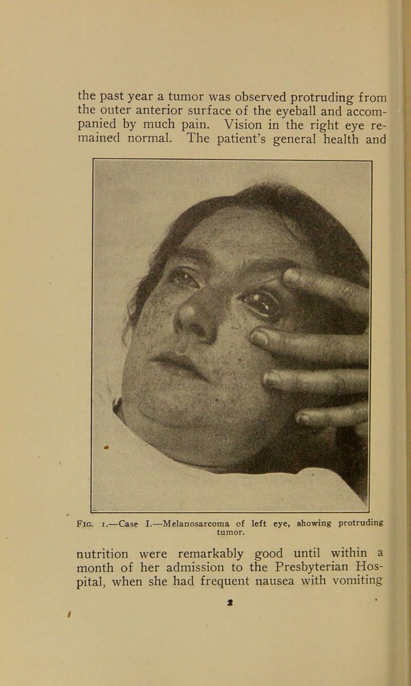 the past year a tumor was observed protruding from the outer anterior surface of the eyeball and accom- panied by much pain. Vision in the right eye re- mained normal. The patient’s general health and Fig. i.—Case I.—Melanosarcoma of left eye, showing protruding tumor. nutrition were remarkably good until within a month of her admission to the Presbyterian Hos- pital, when she had frequent nausea with vomiting < i