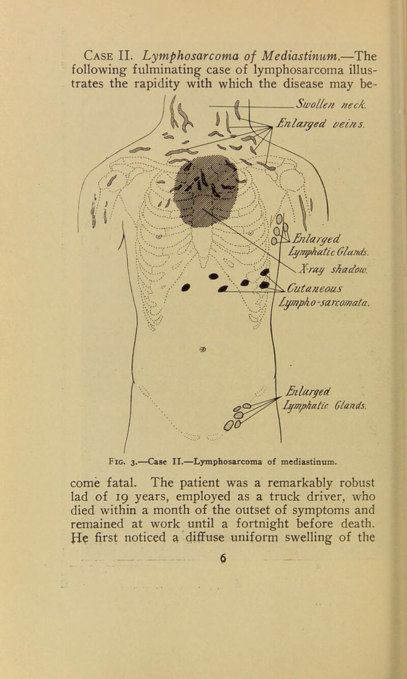 Case II. Lymphosarcoma of Mediastinum.—The following fulminating case of lymphosarcoma illus- trates the rapidity with which the disease may be- Swollen neck. Enlarged veins. Enlarged Lymphatic Glands. X-ray shadow. Cutaneous Lymph o -sarcomata. Enlarged Lymphatic Glands. Fig. 3.—Case II.—Lymphosarcoma of mediastinum. come fatal. The patient was a remarkably robust lad of 19 years, employed as a truck driver, who died within a month of the outset of symptoms and remained at work until a fortnight before death. Jde first noticed a, diffuse uniform swelling of the