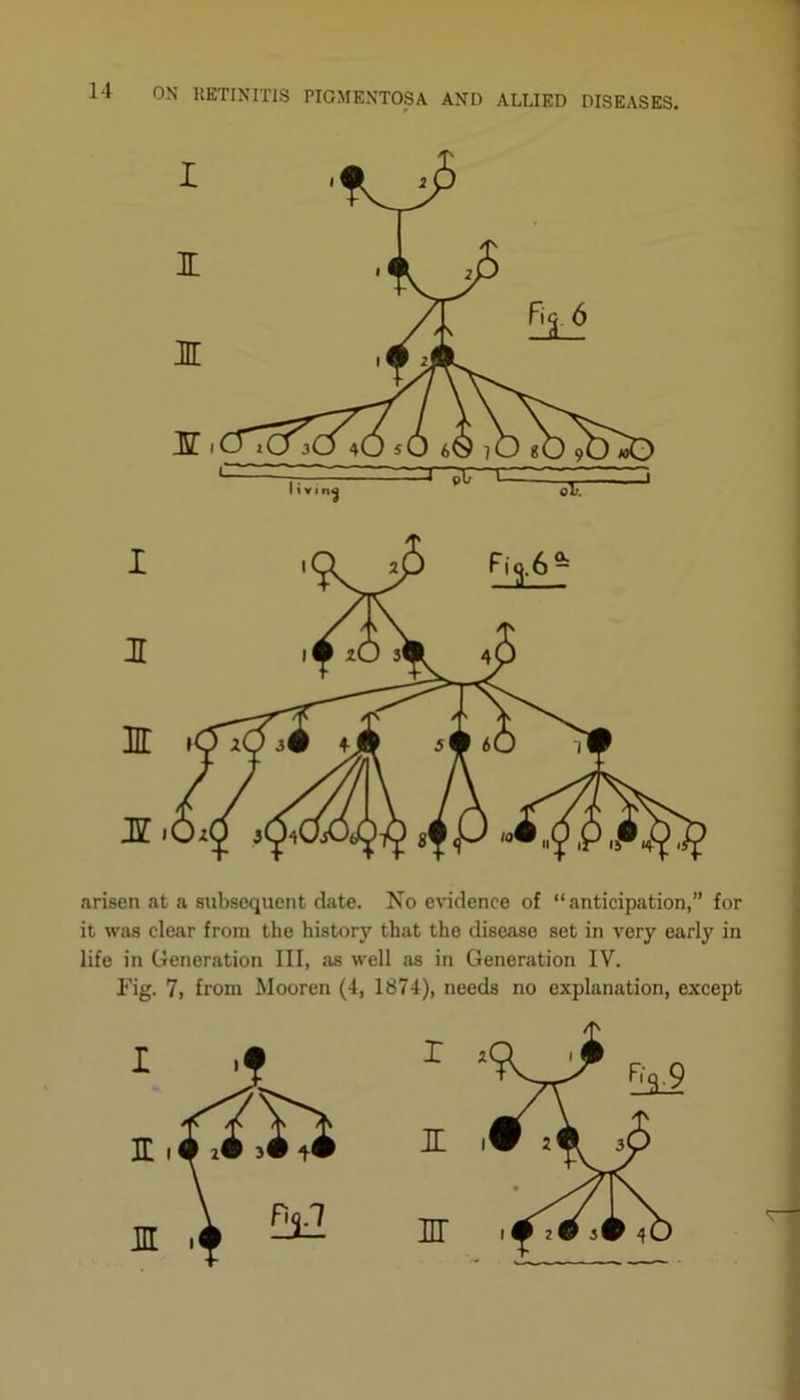 I I M JST. arisen at a subsequent date. No evidence of “anticipation,” for it was clear from the history that the disease set in very early in life in Generation III, as well as in Generation IV. Fig. 7, from Mooren (4, 1874), needs no explanation, except r n m nr i 2Cf $W 4