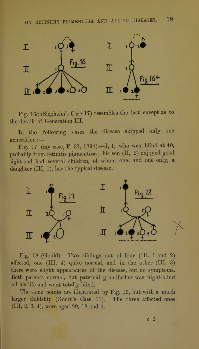 Fig. 16« (Siegheim’s Case 17) resembles the last except as to the details of Generation III. In the following cases the disease skipped only one generation:— Fig. 17 (my case, P. 31, 1894).—I, 1, who was blind at 40, probably from retinitis pigmentosa; his son (II, 2) enjoyed good sight and had several children, of whom one, and one only, a daughter (III, 1), has the typical disease. Fig. 18 (Gould).—Two siblings out of four (III, 1 and 2) affected, one (III, 4) quite normal, and in the other (III, 3) there were slight appearances of the disease, but no symptoms. Both parents normal, but paternal grandfather was night-blind all his life and went totally blind. The same points are illustrated by Fig. 19, but with a much larger childship (Gonin’s Case 11). The three affected ones (III, 2, 3, 4), were aged 20, 18 and 4. c 2