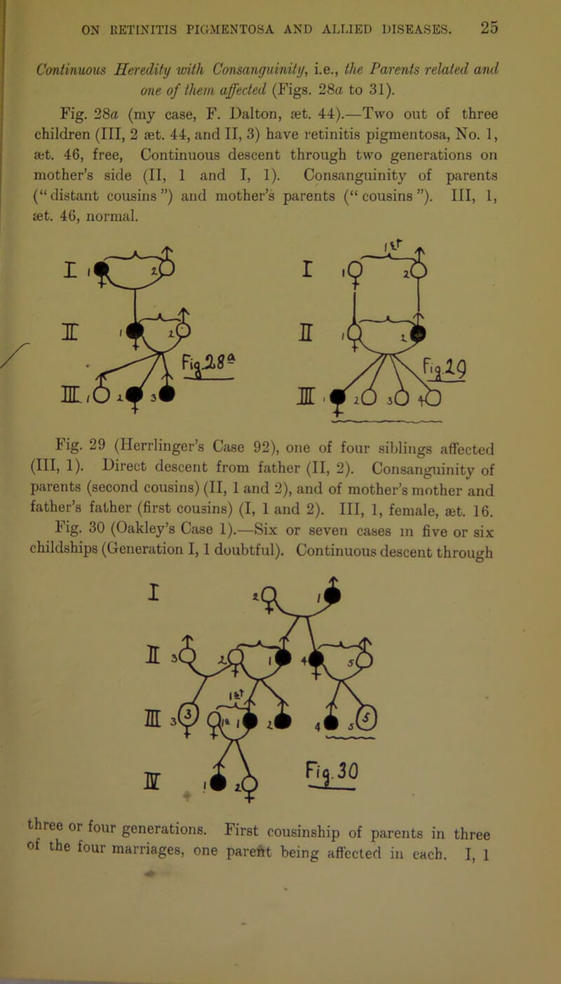 Continuous Heredity with Consanguinity, i.e., the Parents related and one of them affected (Figs. 28a to 31). Fig. 28a (my case, F. Dalton, let. 44).—Two out of three children (III, 2 set. 44, and II, 3) have retinitis pigmentosa, No. 1, ast. 46, free, Continuous descent through two generations on mother’s side (II, 1 and I, 1). Consanguinity of parents (“distant cousins”) and mother’s parents (“cousins”). Ill, 1, let. 46, normal. Fig. 29 (Herrlinger’s Case 92), one of four siblings affected (III, 1). Direct descent from father (II, 2). Consanguinity of parents (second cousins) (II, 1 and 2), and of mother’s mother and father’s father (first cousins) (I, 1 and 2). Ill, 1, female, ajt. 16. Fig. 30 (Oakley’s Case 1).—Six or seven cases in five or six childships (Generation 1,1 doubtful). Continuous descent through I 1 nr IT three or four generations. First cousinship of parents in three of the four marriages, one parent being affected in each. I, 1