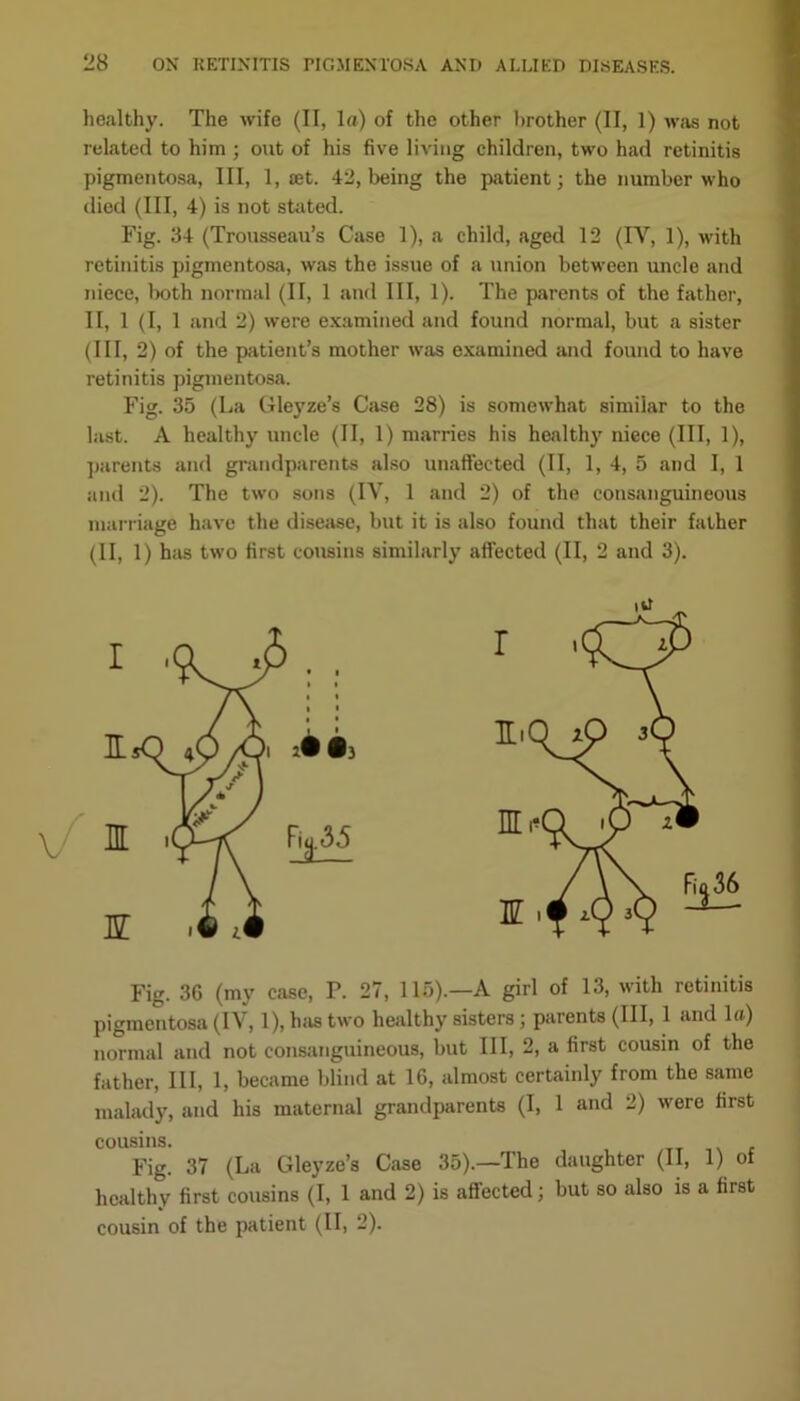 healthy. The wife (II, la) of the other brother (II, 1) was not related to him ; out of his five living children, two had retinitis pigmentosa, III, 1, jet. 42, being the patient; the number who died (III, 4) is not stated. Fig. 34 (Troussejiu’s Case 1), a child, aged 12 (IY, 1), with retinitis pigmentosa, was the issue of a union between uncle and niece, both normal (II, 1 and III, 1). The parents of the father, II, 1 (I, 1 and 2) were examined and found normal, but a sister (III, 2) of the patient’s mother was examined and found to have retinitis pigmentosa. Fig. 35 (La Gleyze’s Case 28) is somewhat similar to the hist. A healthy uncle (II, 1) marries his healthy niece (III, 1), parents and grandparents also unaffected (II, 1, 4, 5 and I, 1 and 2). The two sons (IV, 1 and 2) of the consanguineous marriage have the disease, but it is also found that their father (II, 1) has two first cousins similarly affected (II, 2 and 3). Fig. 3G (my ease, F. 27, 115).—A girl of 13, with retinitis pigmentosa (I\ , 1), has two healthy sisters; parents (III, 1 and la) normal and not consanguineous, but III, 2, a first cousin of the father, III, 1, became blind at 16, almost certainly from the same malady, and his maternal grandparents (I, 1 and 2) were first cousins. Fig. 37 (La Gleyze’s Case 35).—The daughter (II, 1) of healthy first cousins (I, 1 and 2) is affected; but so also is a first cousin of the patient (II, 2).