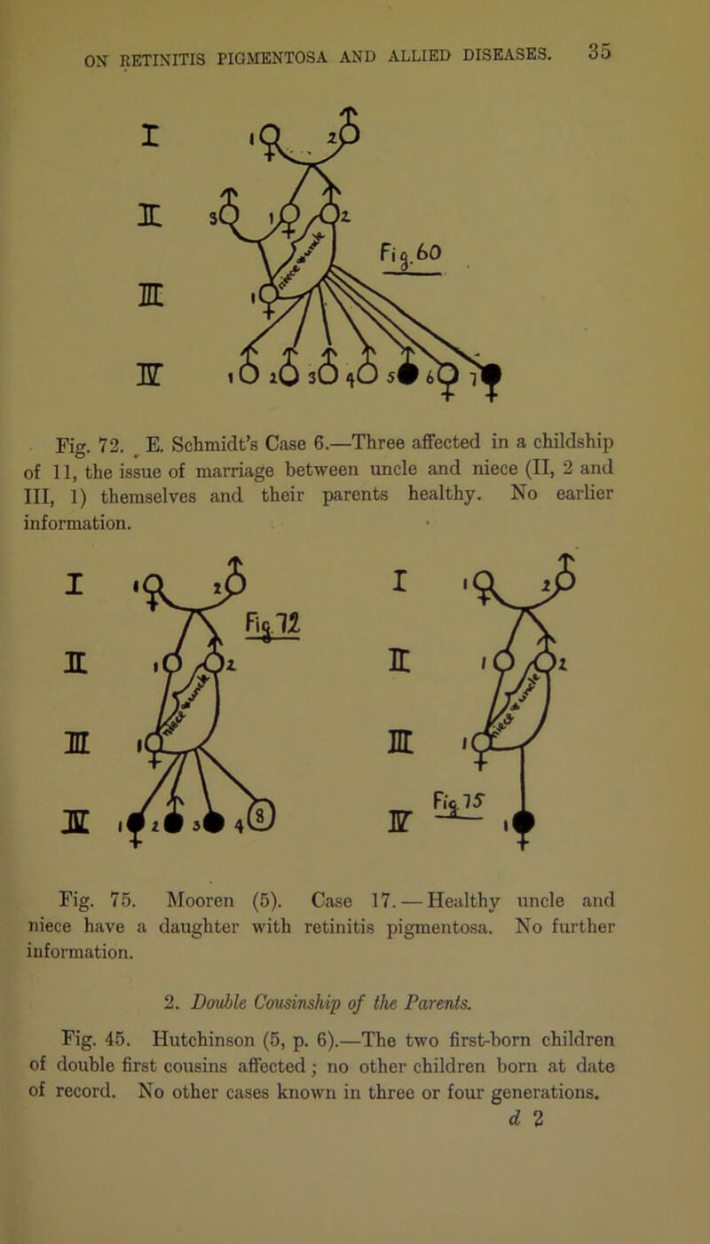 Fig. 72. E. Schmidt’s Case 6.—Three affected in a childship of 11, the issue of marriage between uncle and niece (II, 2 and III, 1) themselves and their parents healthy. No earlier information. Fig. 75. Mooren (5). Case 17. — Healthy uncle and niece have a daughter with retinitis pigmentosa. No further information. 2. Double Cousinship of the Parents. Fig. 45. Hutchinson (5, p. 6).—The two first-born children of double first cousins affected; no other children born at date of record. No other cases known in three or four generations. d 2