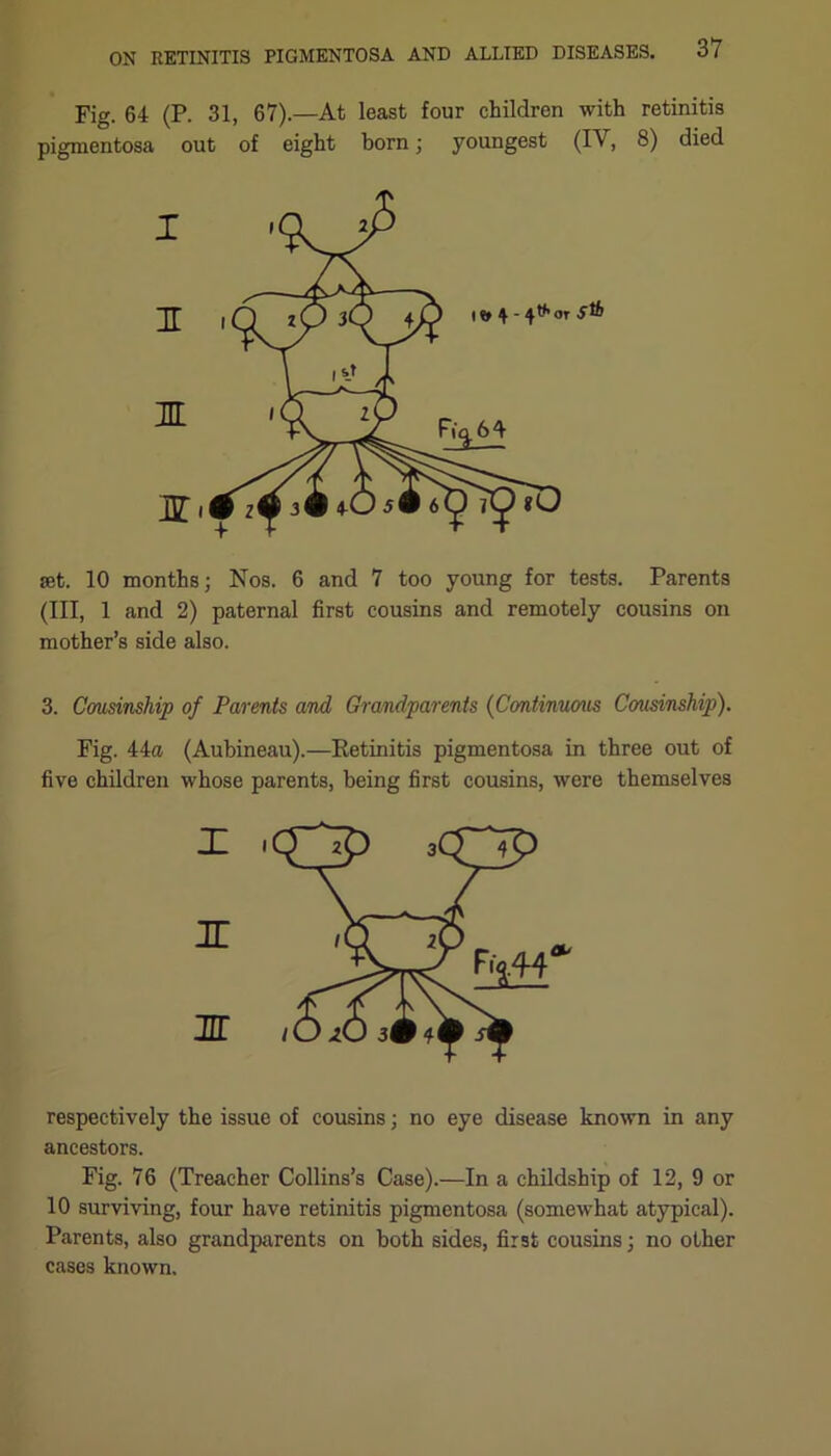 Fig. 64 (P. 31, 67).—At least four children with retinitis pigmentosa out of eight born; youngest (IV, 8) died X IT XL XT' set. 10 months; Nos. 6 and 7 too young for tests. Parents (III, 1 and 2) paternal first cousins and remotely cousins on mother’s side also. 3. Cousinship of Parents and Grandparents (Continuous Corasinship). Fig. 44a (Aubineau).—Retinitis pigmentosa in three out of five children whose parents, being first cousins, were themselves respectively the issue of cousins; no eye disease known in any ancestors. Fig. 76 (Treacher Collins’s Case).—In a childship of 12, 9 or 10 surviving, four have retinitis pigmentosa (somewhat atypical). Parents, also grandparents on both sides, first cousins; no other cases known.