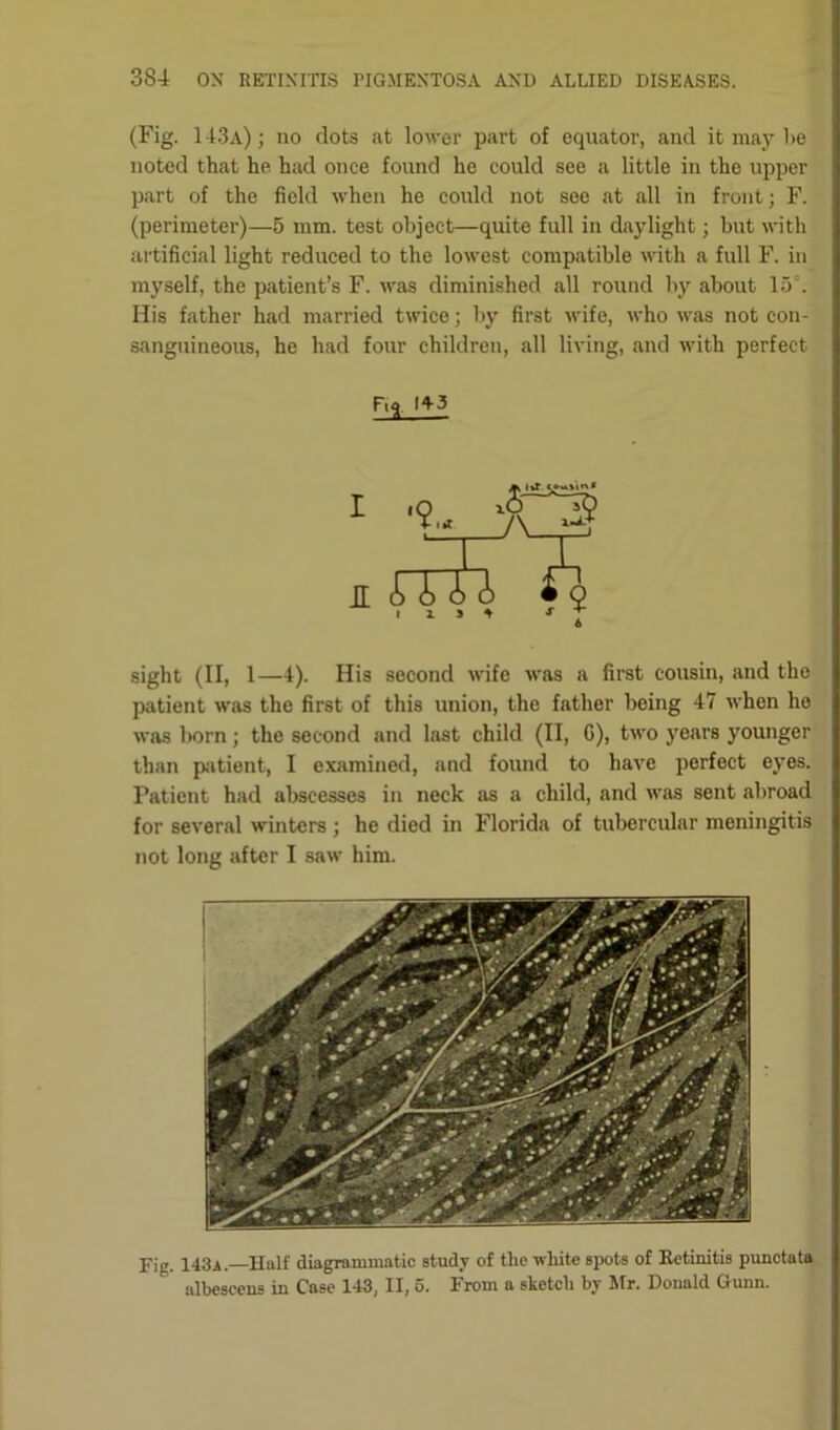 (Fig. 1 43a) ; no dots at lower part of equator, and it may be noted that he had once found he could see a little in the upper part of the field when he could not see at all in front; F. (perimeter)—5 mm. test object—quite full in daylight; but with artificial light reduced to the lowest compatible with a full F. in myself, the patient’s F. was diminished all round by about 15 \ His father had married twice; by first wife, who was not con- sanguineous, he had four children, all living, and with perfect Ftft 14-3 I £ sight (II, 1—4). His second wife was a first cousin, and the patient was the first of this union, the father being 47 when he was born; the second and last child (II, G), two years younger than patient, I examined, and found to have perfect eyes. Patient had abscesses in neck as a child, and was sent abroad for several winters ; he died in Florida of tubercular meningitis not long after I saw him. Fig. 143a. Half diagrammatic study of the white spots of Retinitis punctata albescens in Case 143, II, 5. From a sketch by Mr. Donald Gunn.